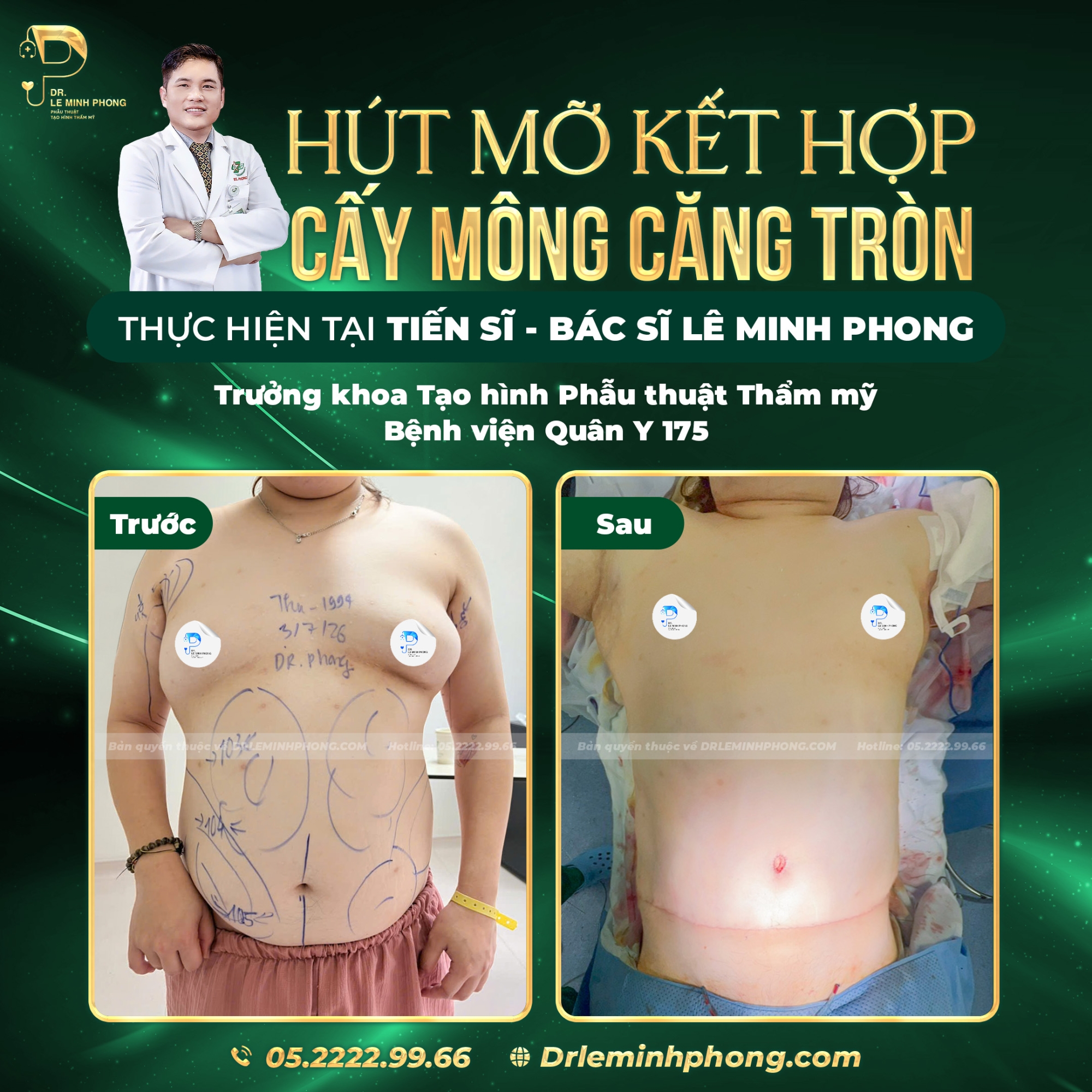 Kiến Tạo Eo Thon – Mông Cong Với Hút Mỡ Và Cấy Mỡ Tự Thân