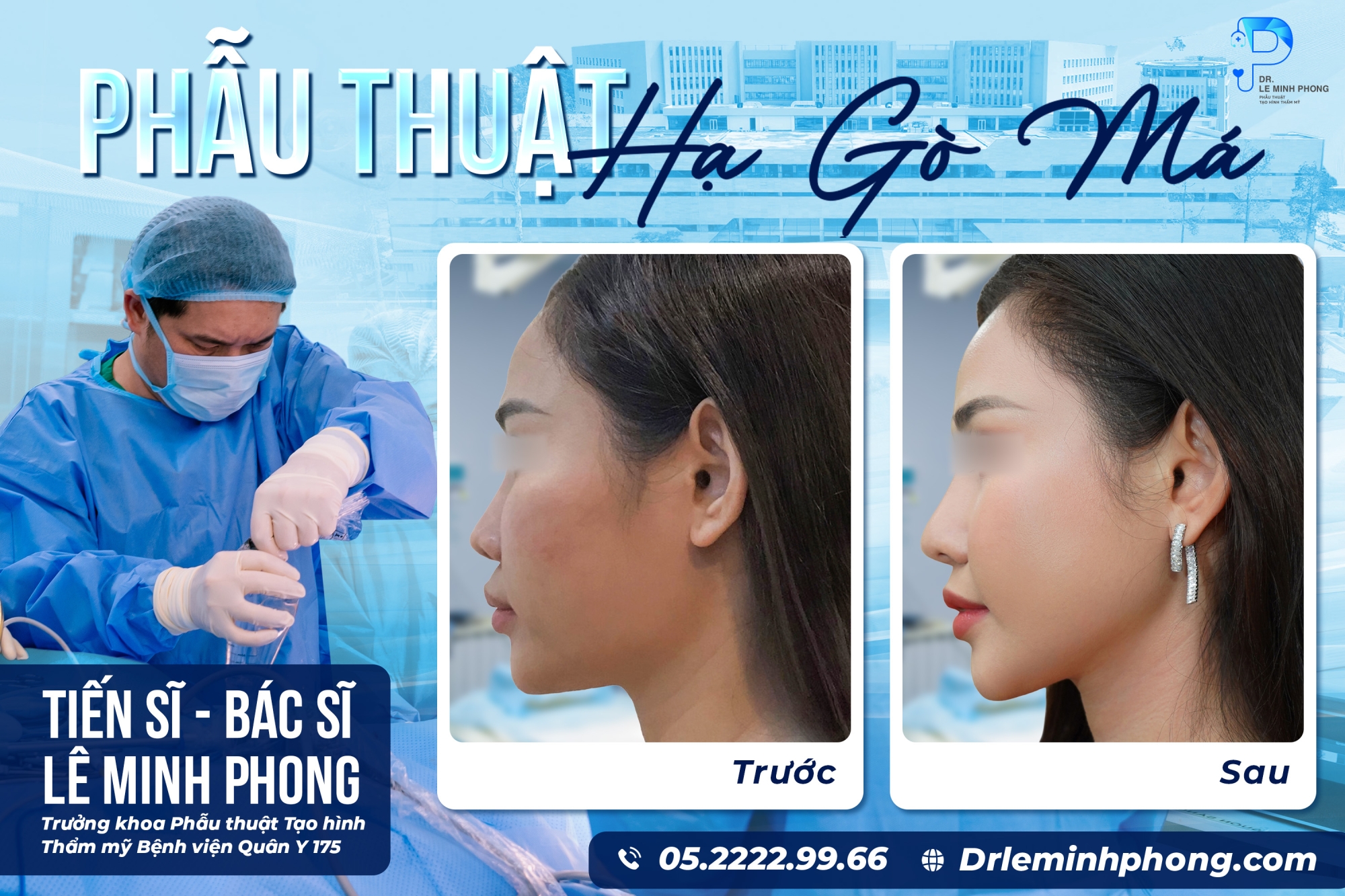 Hạ Gò Má Cao – Cải Thiện Đường Nét Khuôn Mặt Mềm Mại Hơn