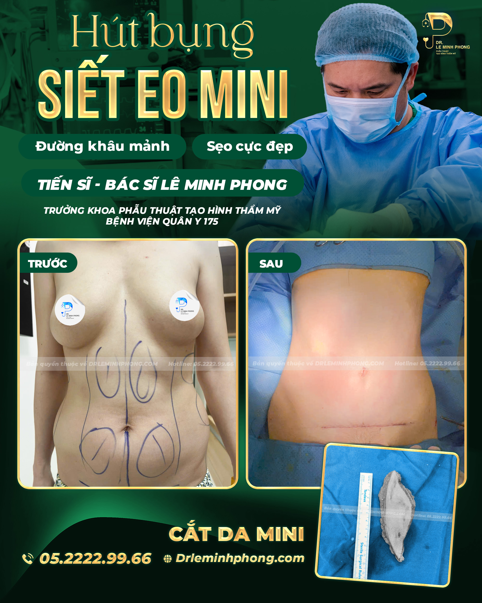 Hút bụng siết eo Mini - Đường khâu mảnh. Sẹo cực đẹp.