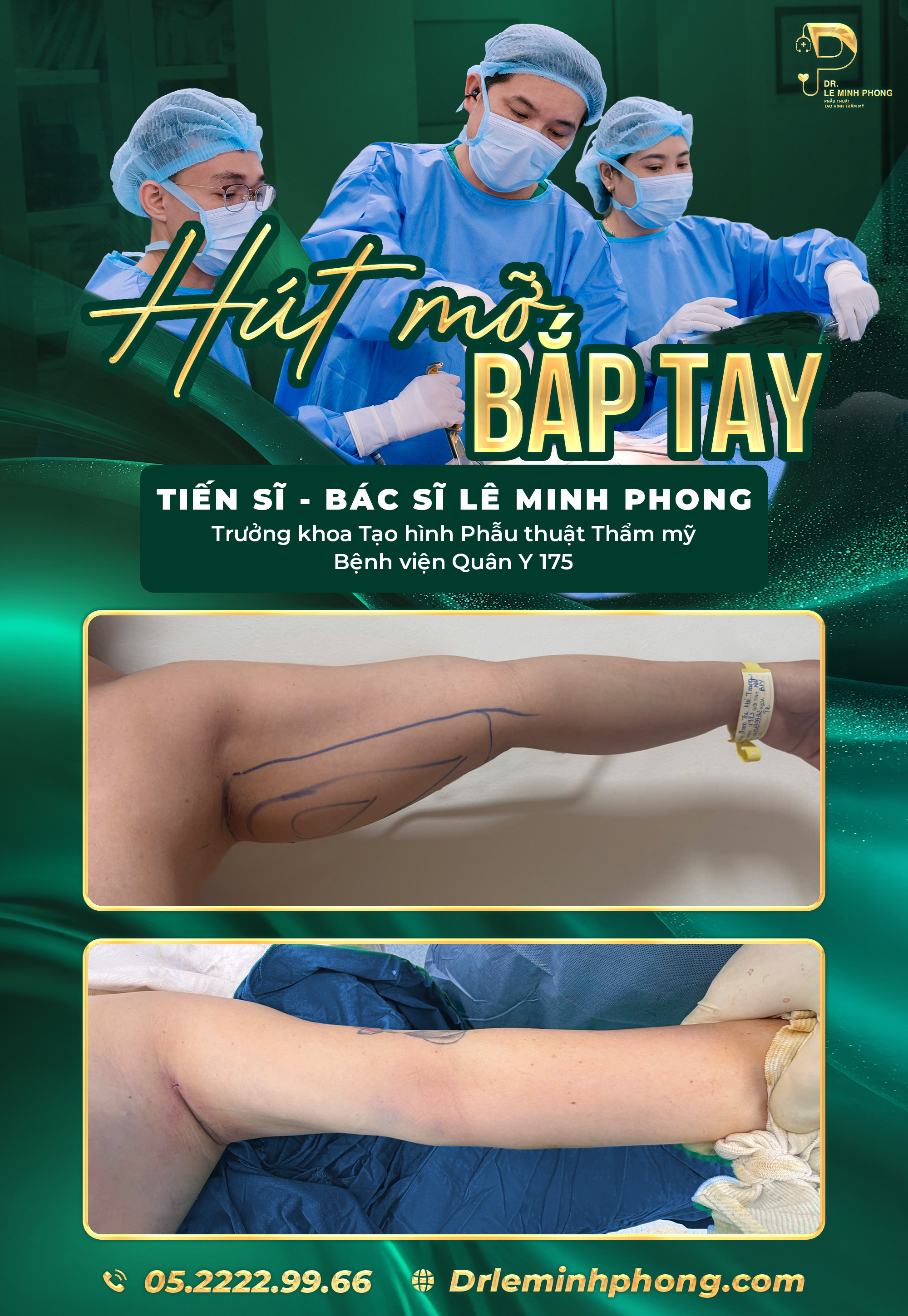Hút mỡ tay thon gọn