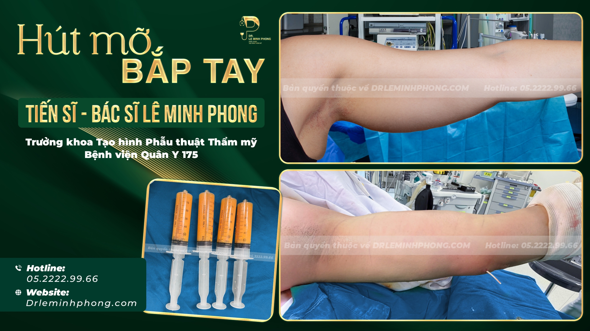 Hút Mỡ Bắp Tay Bởi TS.BS Lê Minh Phong – Trưởng khoa Thẩm mỹ BV Quân Y 175