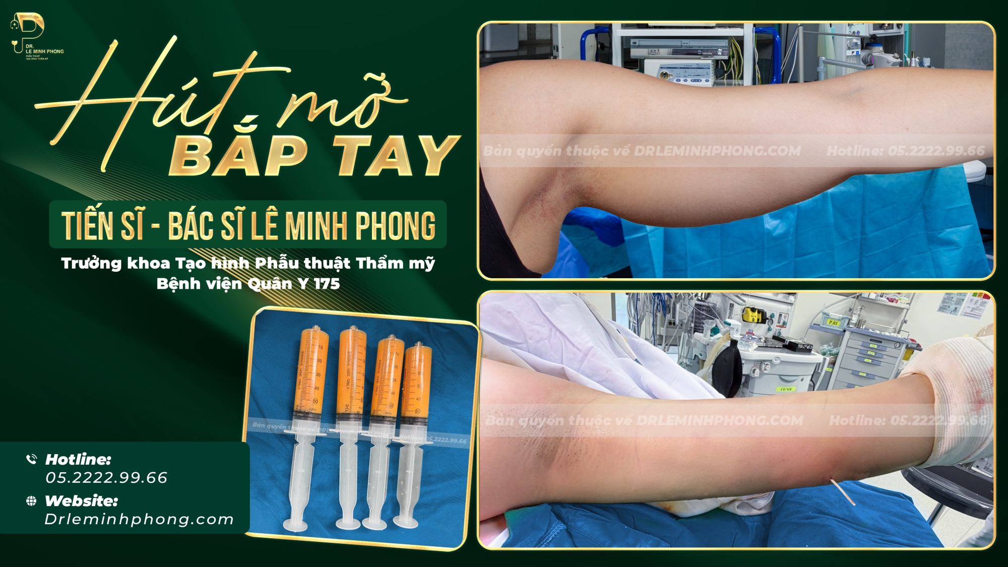 Hút mỡ bắp tay 30p về trong ngày