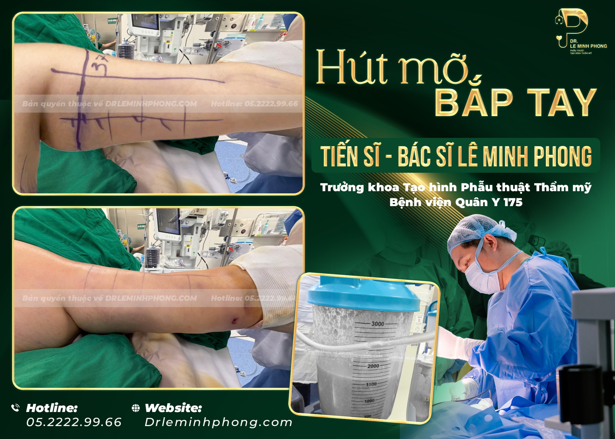 Hút Mỡ Bắp Tay – Giải Pháp Cho Cánh Tay Thon Gọn Tự Nhiên