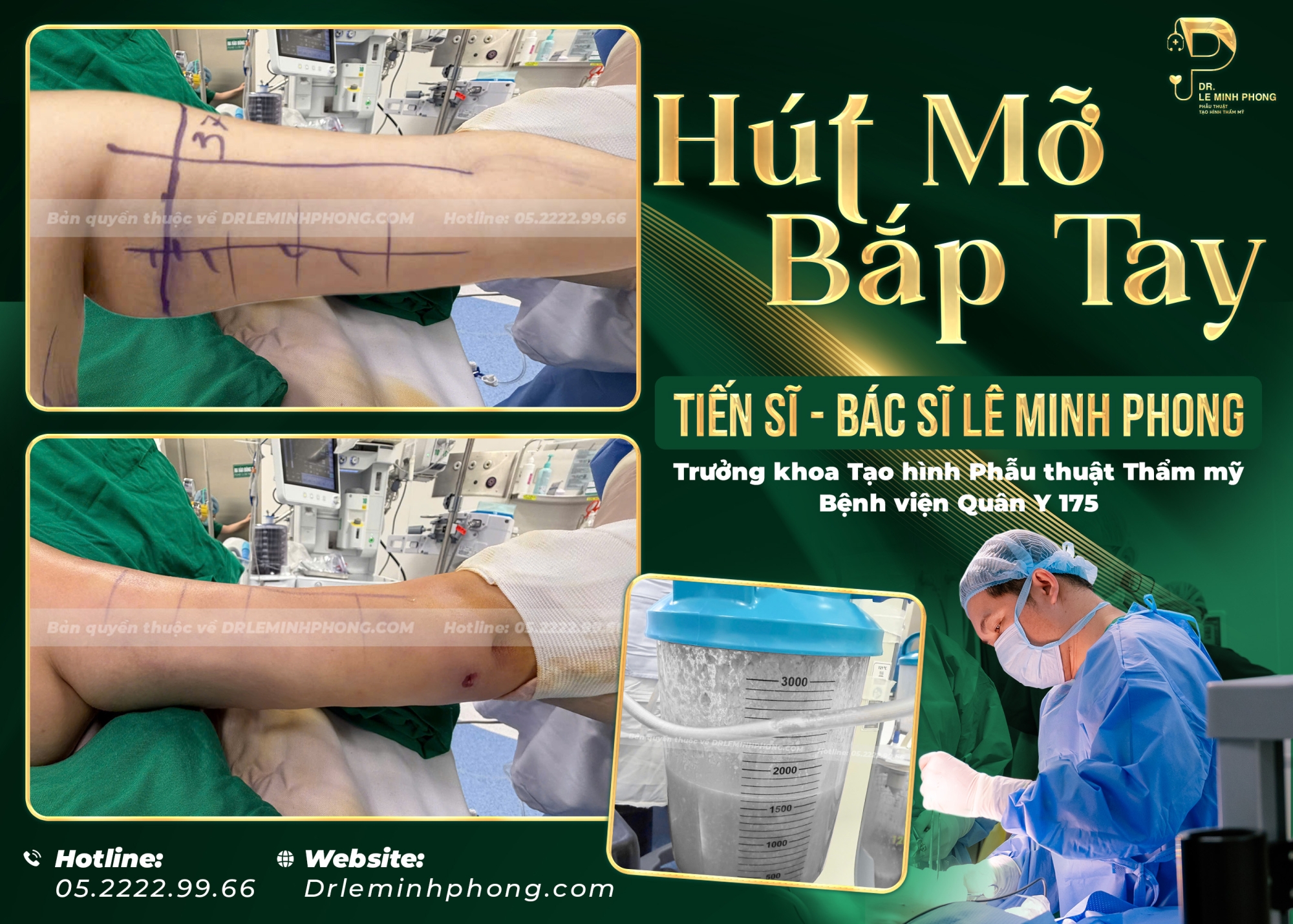 Hút mỡ bắp tay chỉ 30p, nhẹ nhàng, về trong ngày, không nghỉ dưỡng 