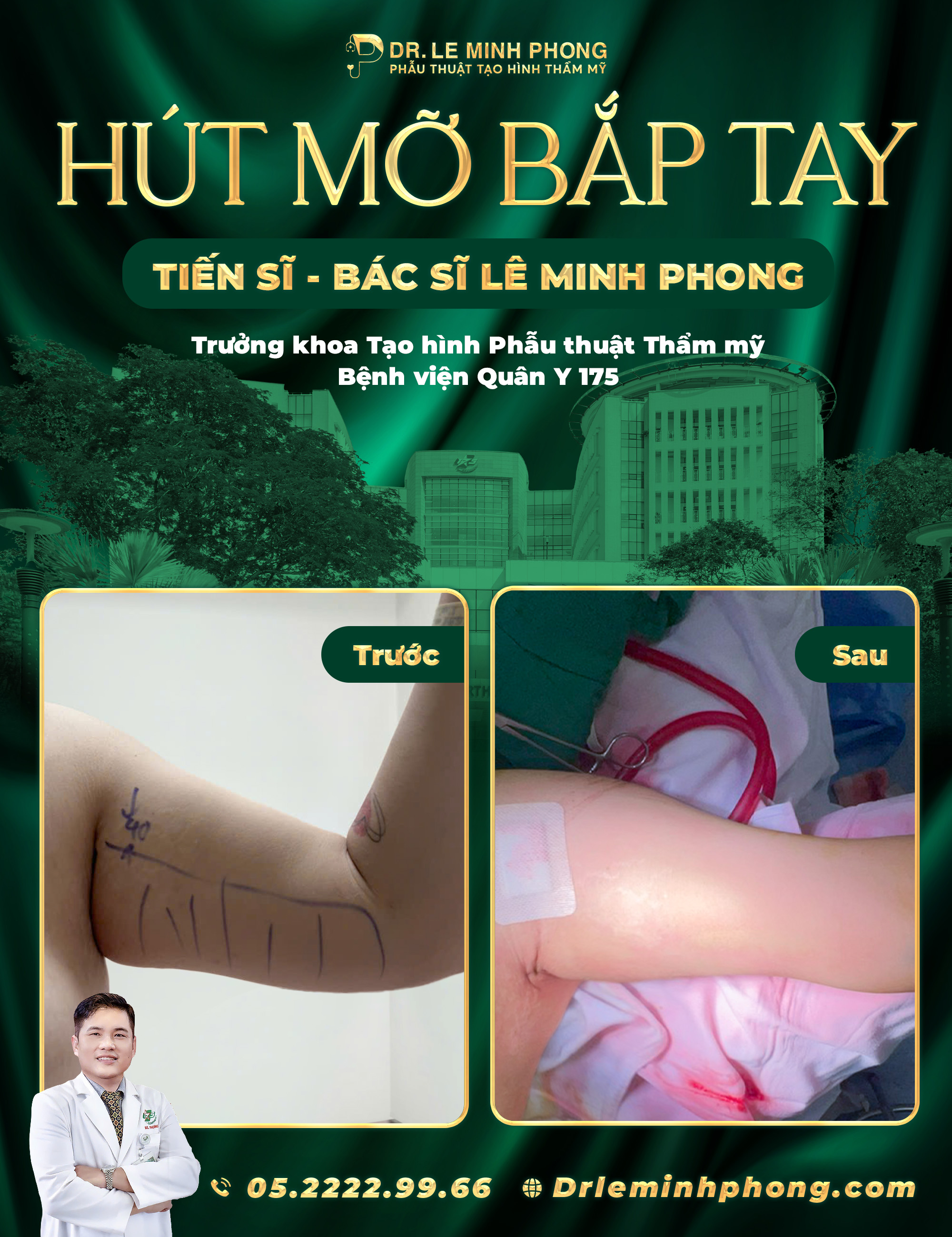 Hút mỡ bắp tay tại Dr Phong