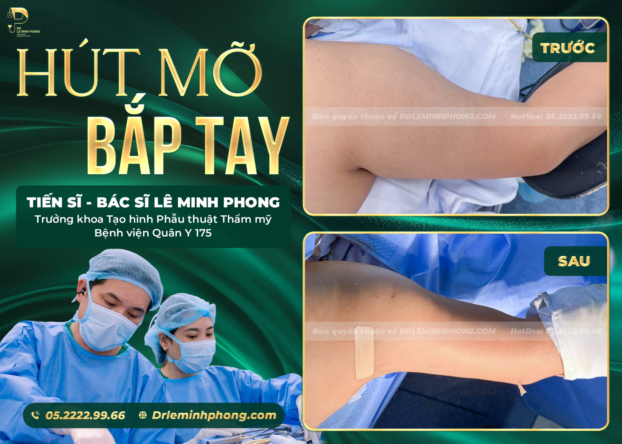 Hút mỡ bắp tay