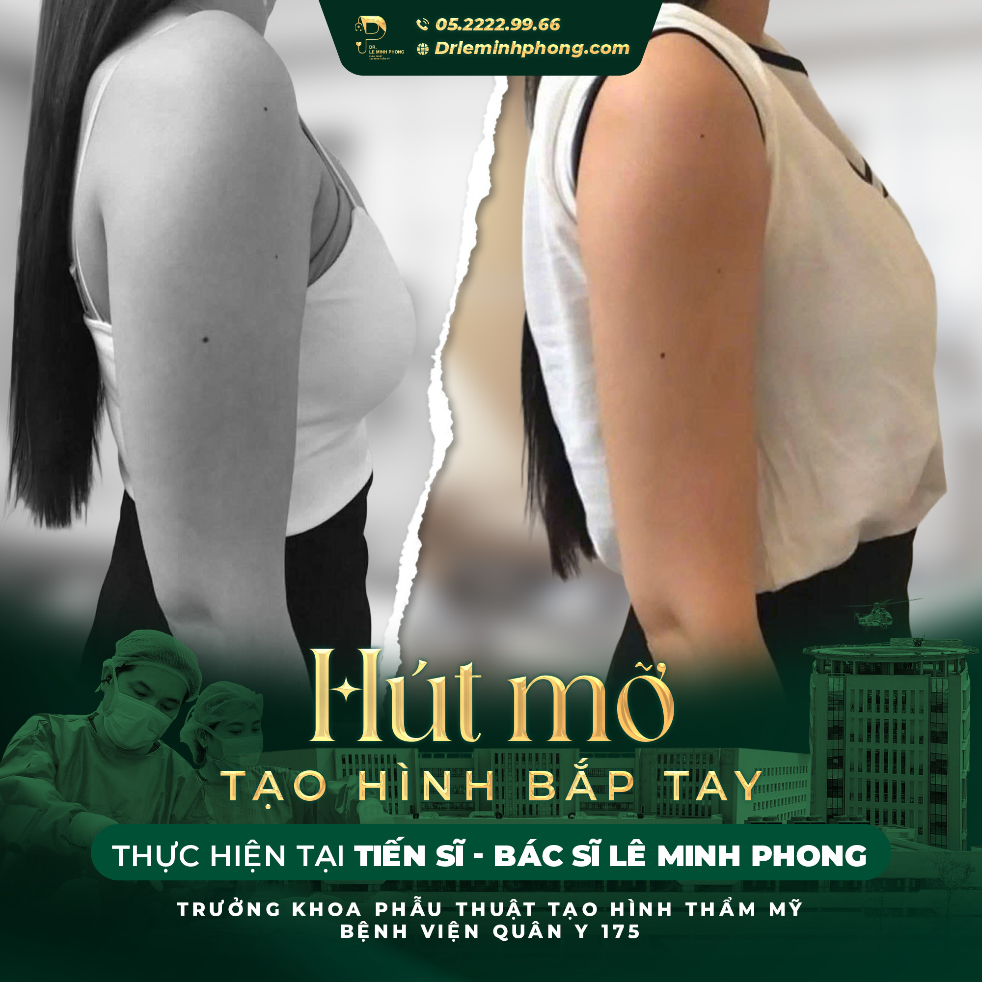 Hút mỡ bắp tay 01