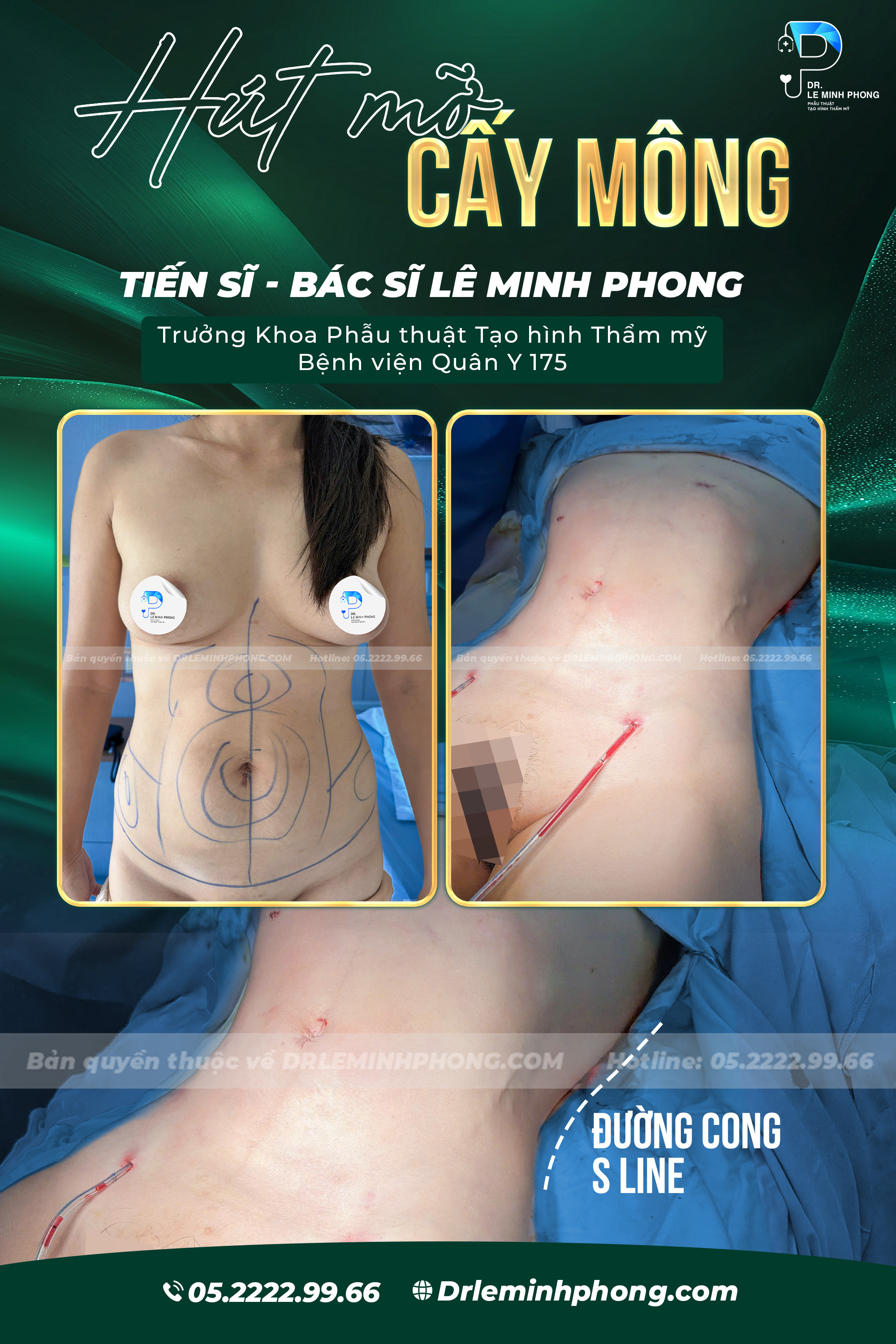 Combo hút bụng không cắt da kết hợp cấy mỡ mông,