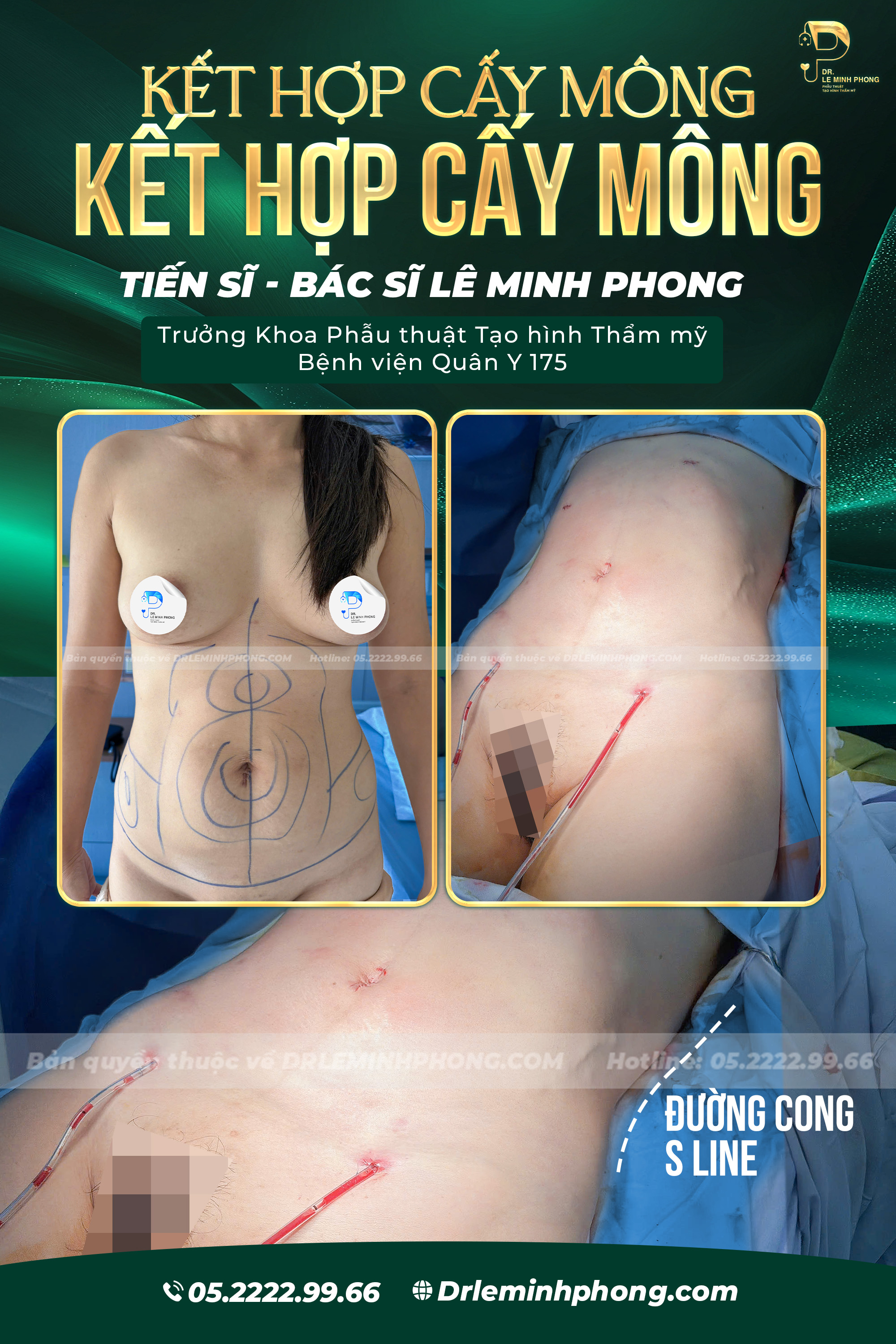 Combo Hút Mỡ Bụng Và Cấy Mỡ Mông Tự Thân