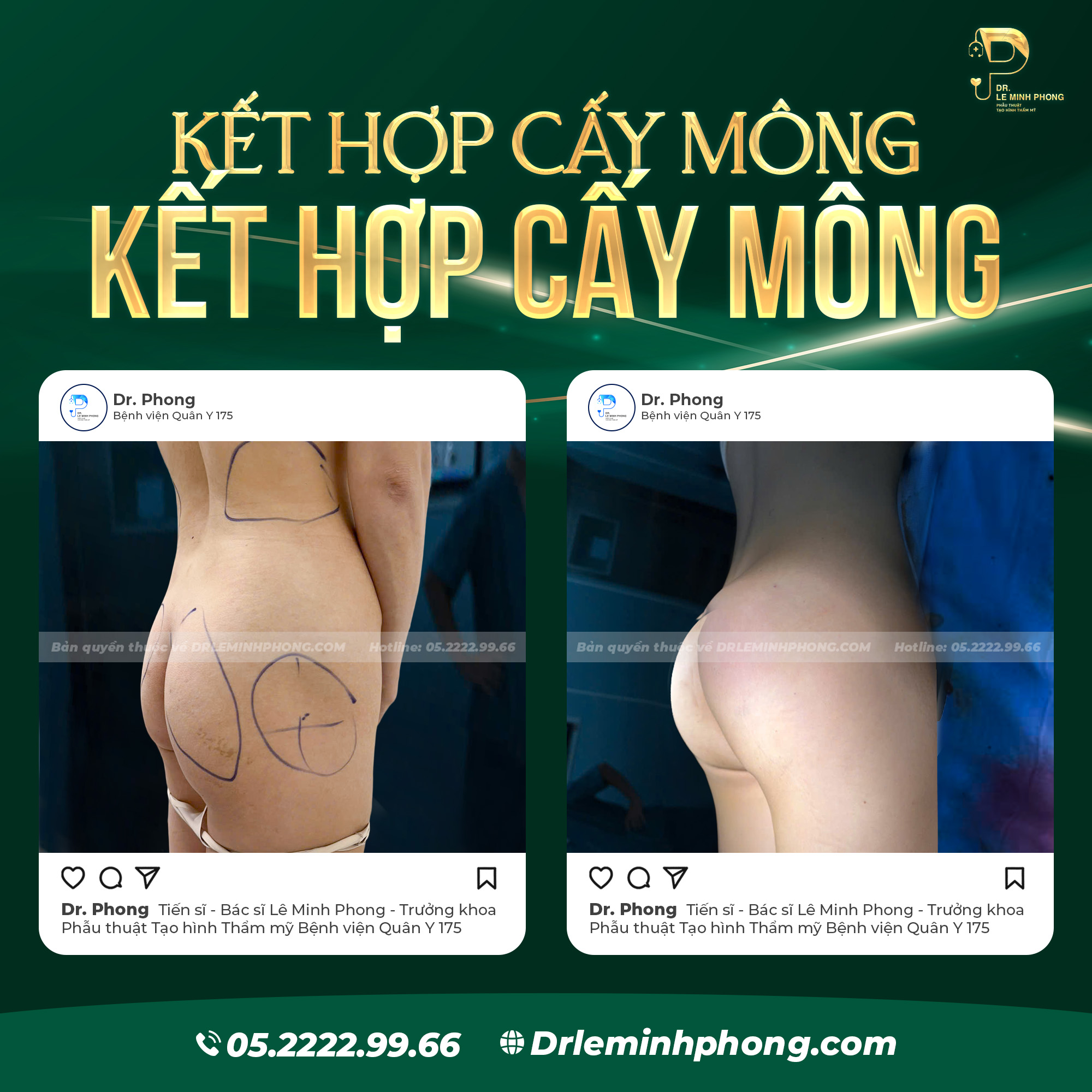 Cấy Mỡ Mông Tự Thân Từ Mỡ Bụng – Giải Pháp Tối Ưu Đường Cong