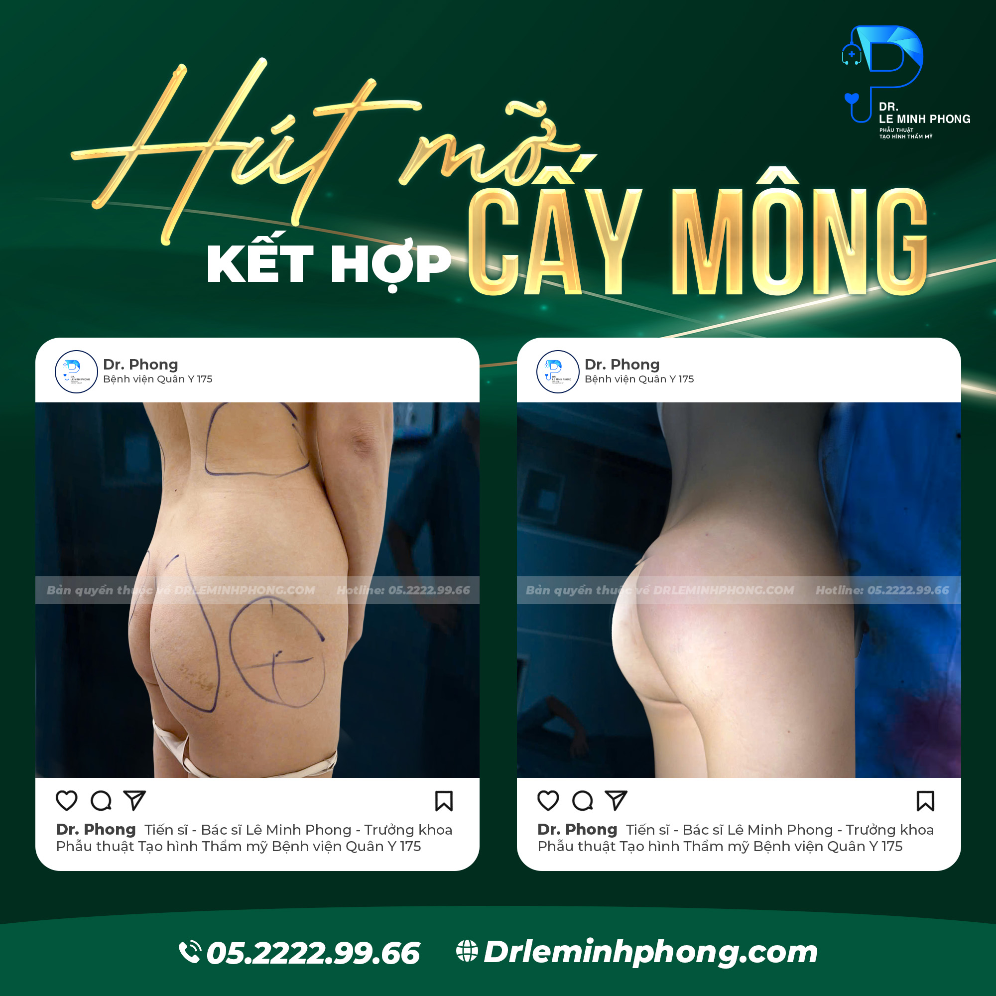Hút mỡ bụng cấy mông tạo fom mông đào căng tròn