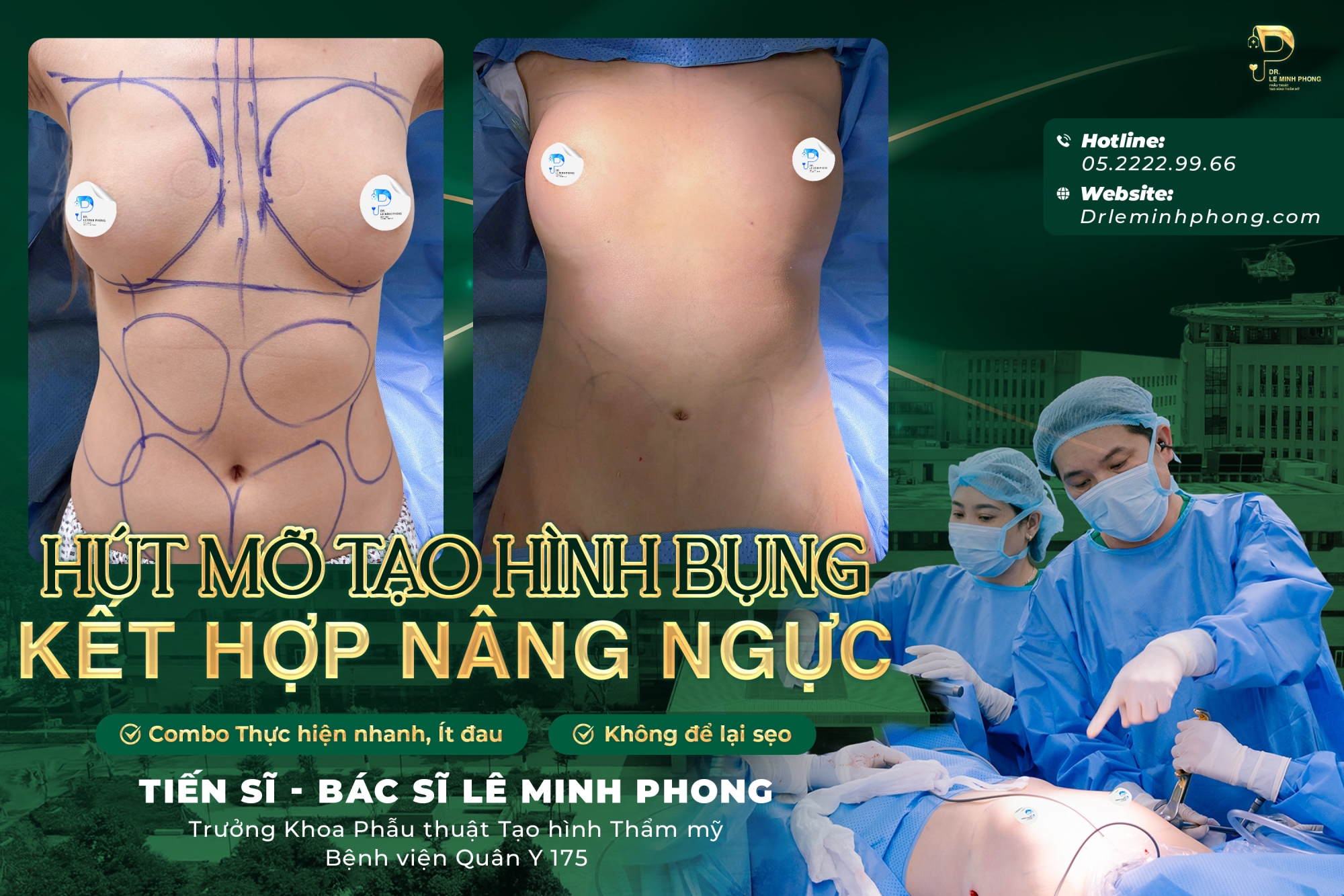 Combo Hút Mỡ Bụng Và Nâng Ngực – Giải Pháp Thay Đổi Đường Cong Toàn Diện