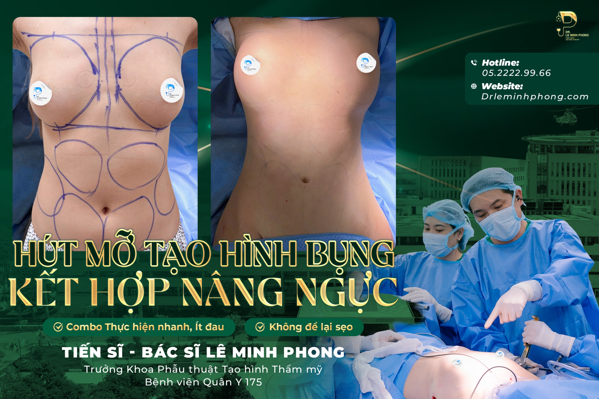 Combo hút mỡ không cắt da, nâng ngực đường bên hông sườn ngực