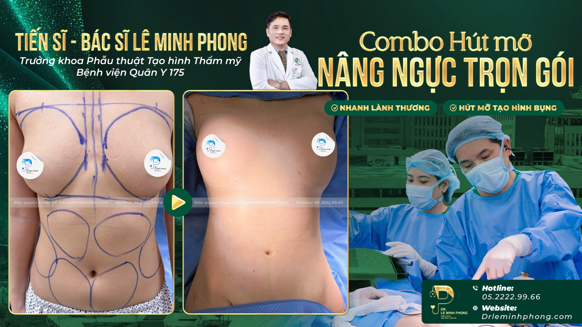 Hút Mỡ Bụng Kết Hợp Nâng Ngực – Giải Pháp Cho Chị Em Sau Sinh