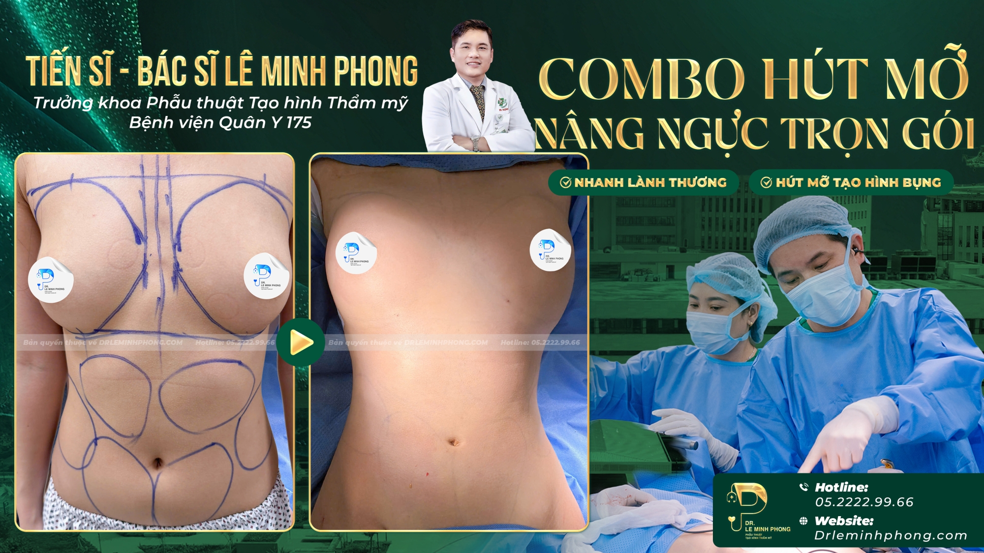Combo hút mỡ kết hợp nâng ngực đường nâng bên hông sườn, ngực nhỏ có mô tuyến