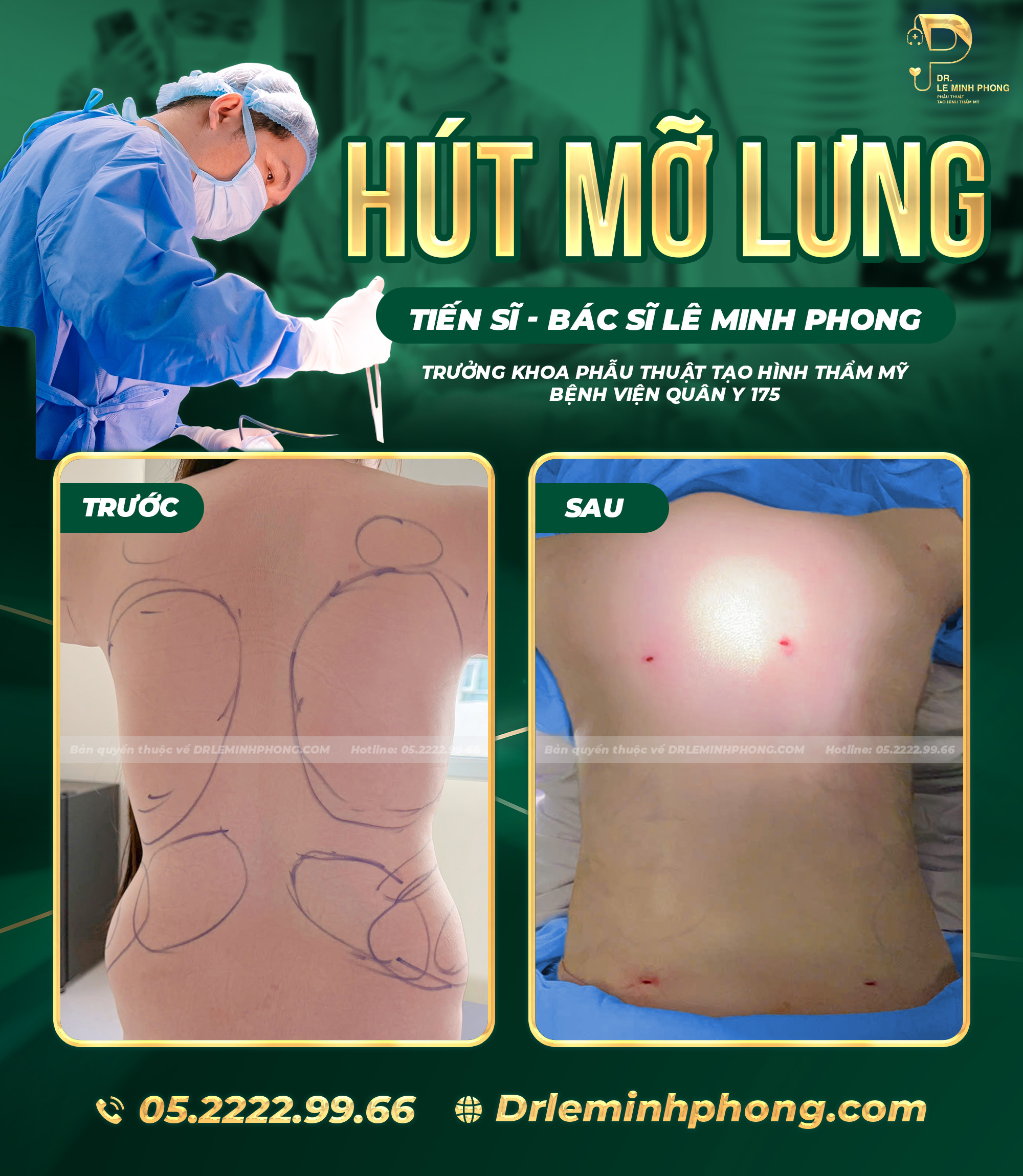 Hút Mỡ Lưng – Giải Pháp Loại Bỏ Mỡ Thừa, Tạo Đường Cong Cân Đối