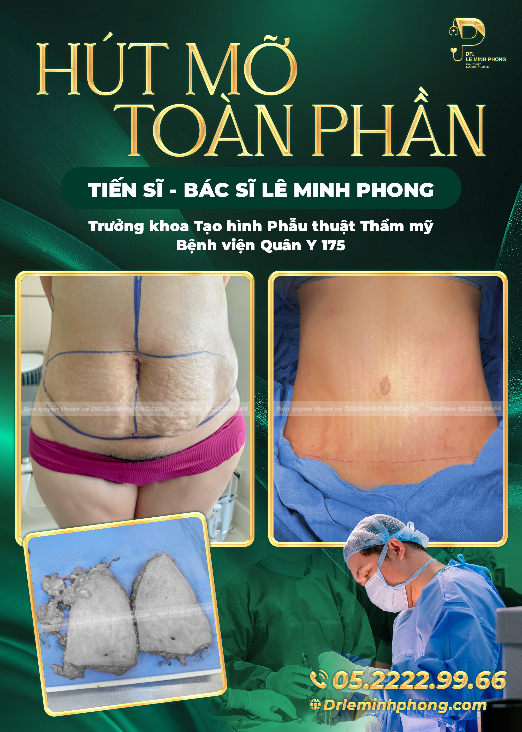 Hút Mỡ Toàn Phần – Kiến Tạo Vóc Dáng Chuẩn Tỷ Lệ Vàng thực hiện TS BS Lê Minh Phong