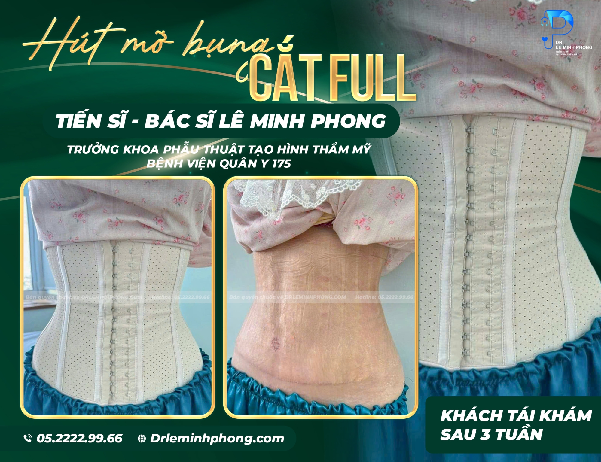 Hút mỡ 360° kết hợp cắt da full giúp cơ thể gọn gàng, săn chắc sau 3 tuần