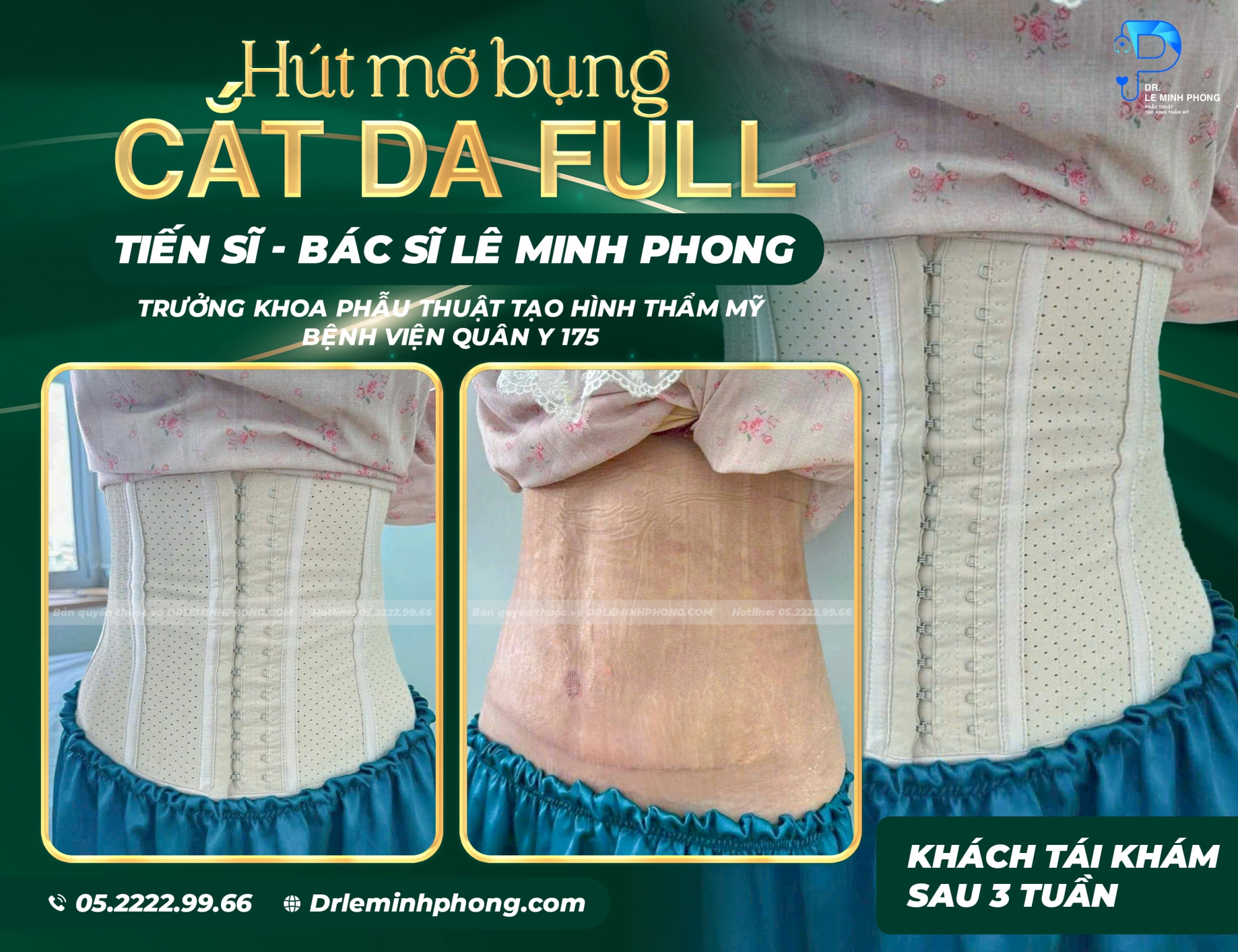 Hút mỡ bụng, cắt da full kiến tạo lại vòng eo