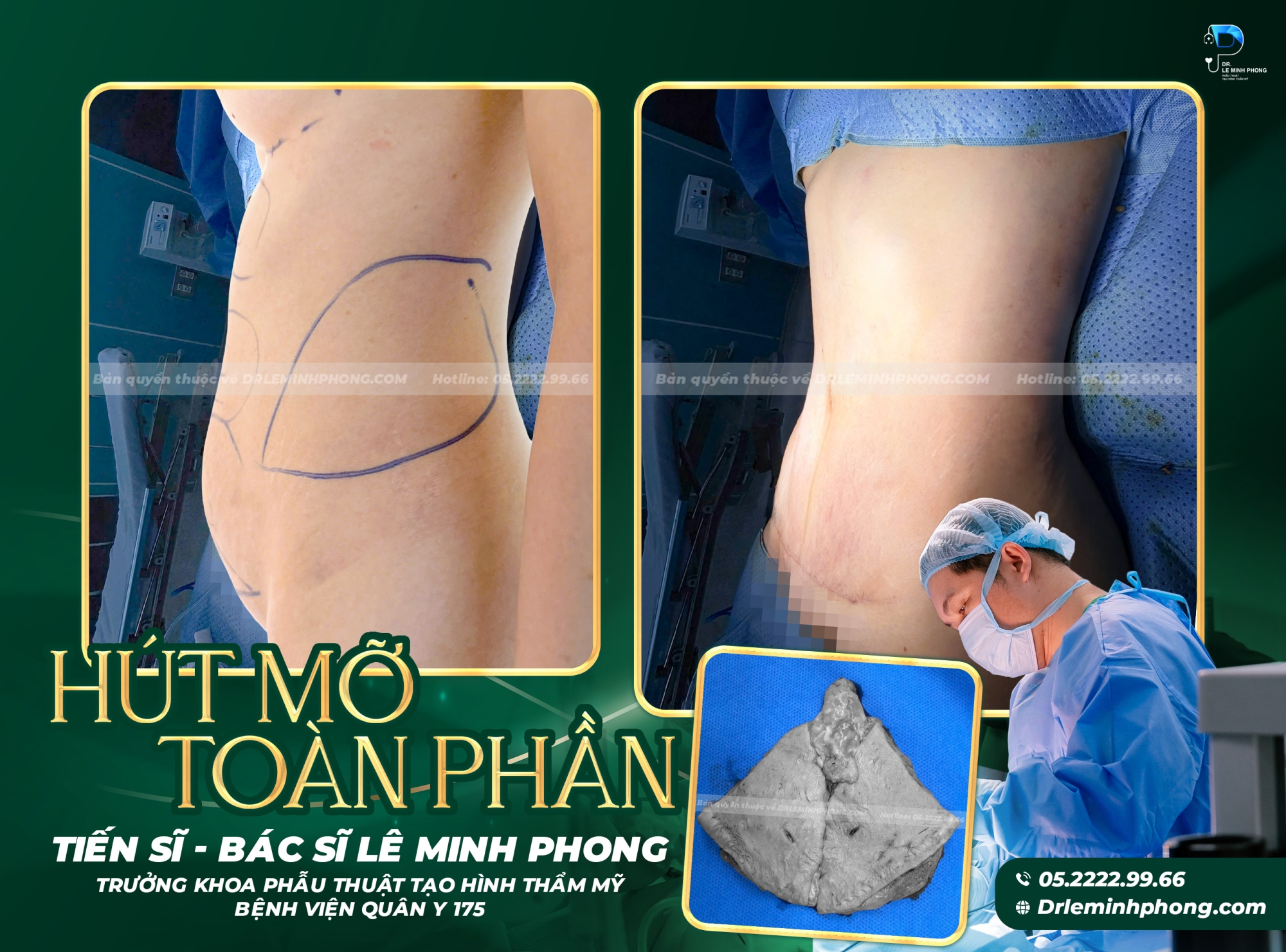 Hút Mỡ Toàn Thân – Giải Pháp Cải Thiện Vóc Dáng Toàn Diện