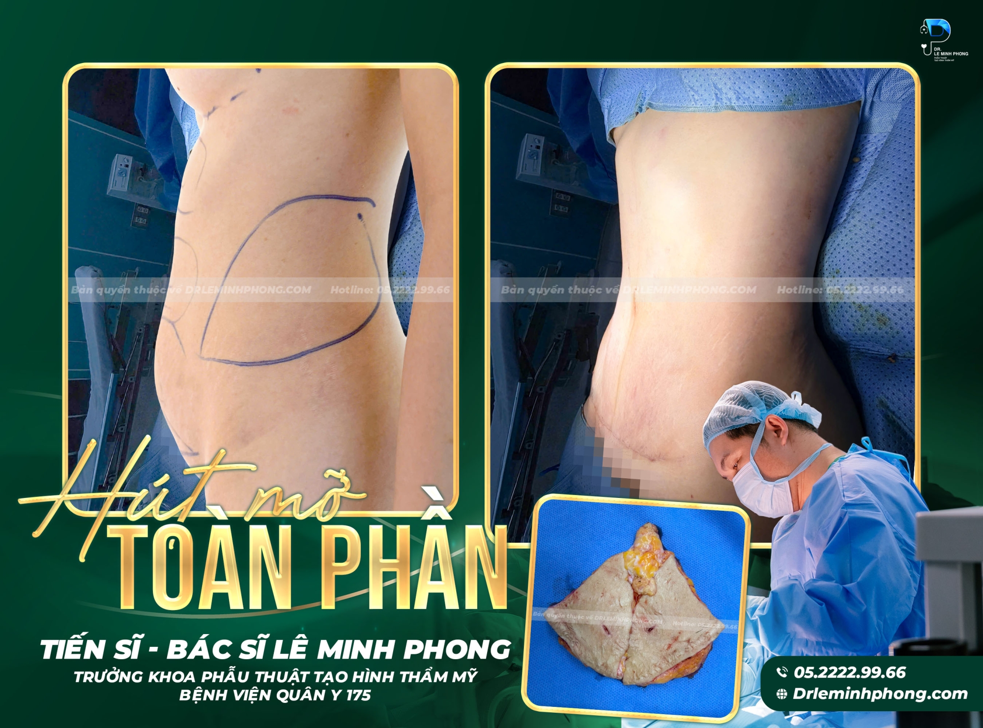 Hút mỡ, cắt da trùng, siết eo tạo hình bụng, KH bụng nhỏ nhưng da trùng nhiều