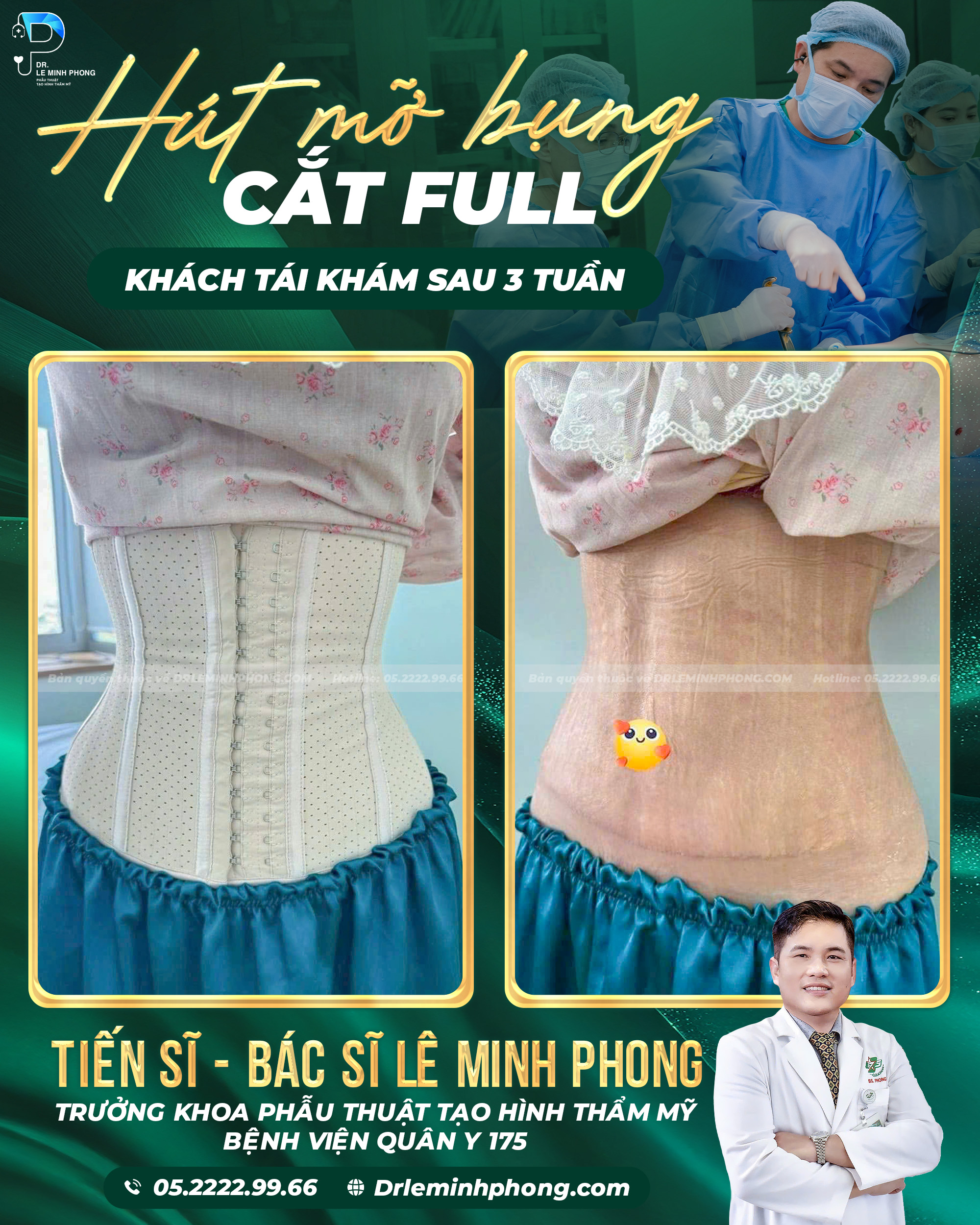 Hút mỡ 360° kết hợp cắt da full – tái định hình đường cong cơ thể sau 3 tuần