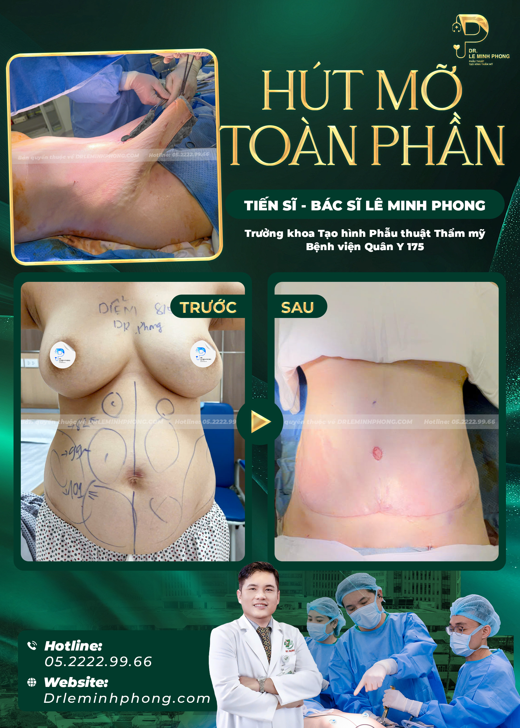 Hút Mỡ Toàn Phần: Giải Pháp Cho Người Tích Mỡ Nhiều Vùng