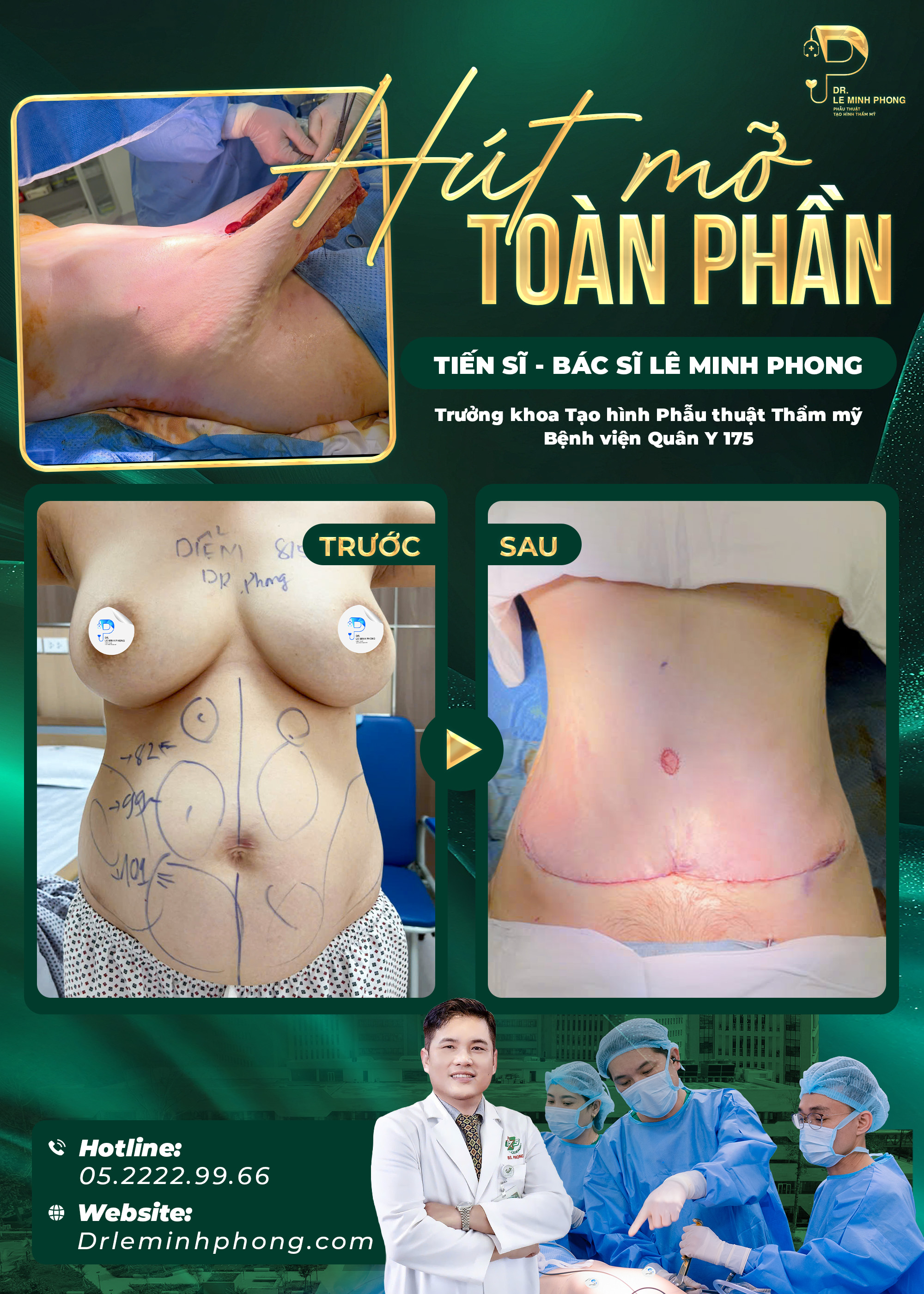 Hút mỡ cắt da full, dời rốn, tạo hình bụng, bụng phì to