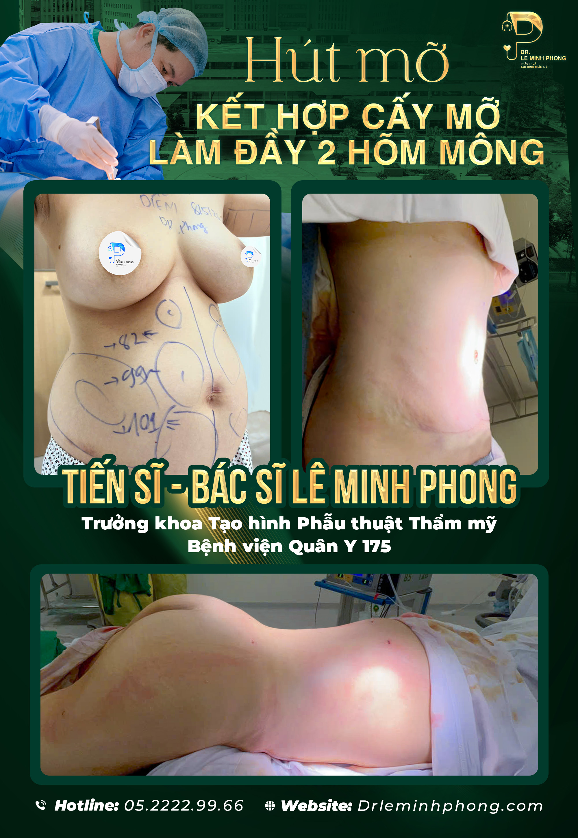 Hút mỡ kết hợp cấy mỡ làm đầy 2 hõm mông thực hiện TS BS Lê Minh Phong