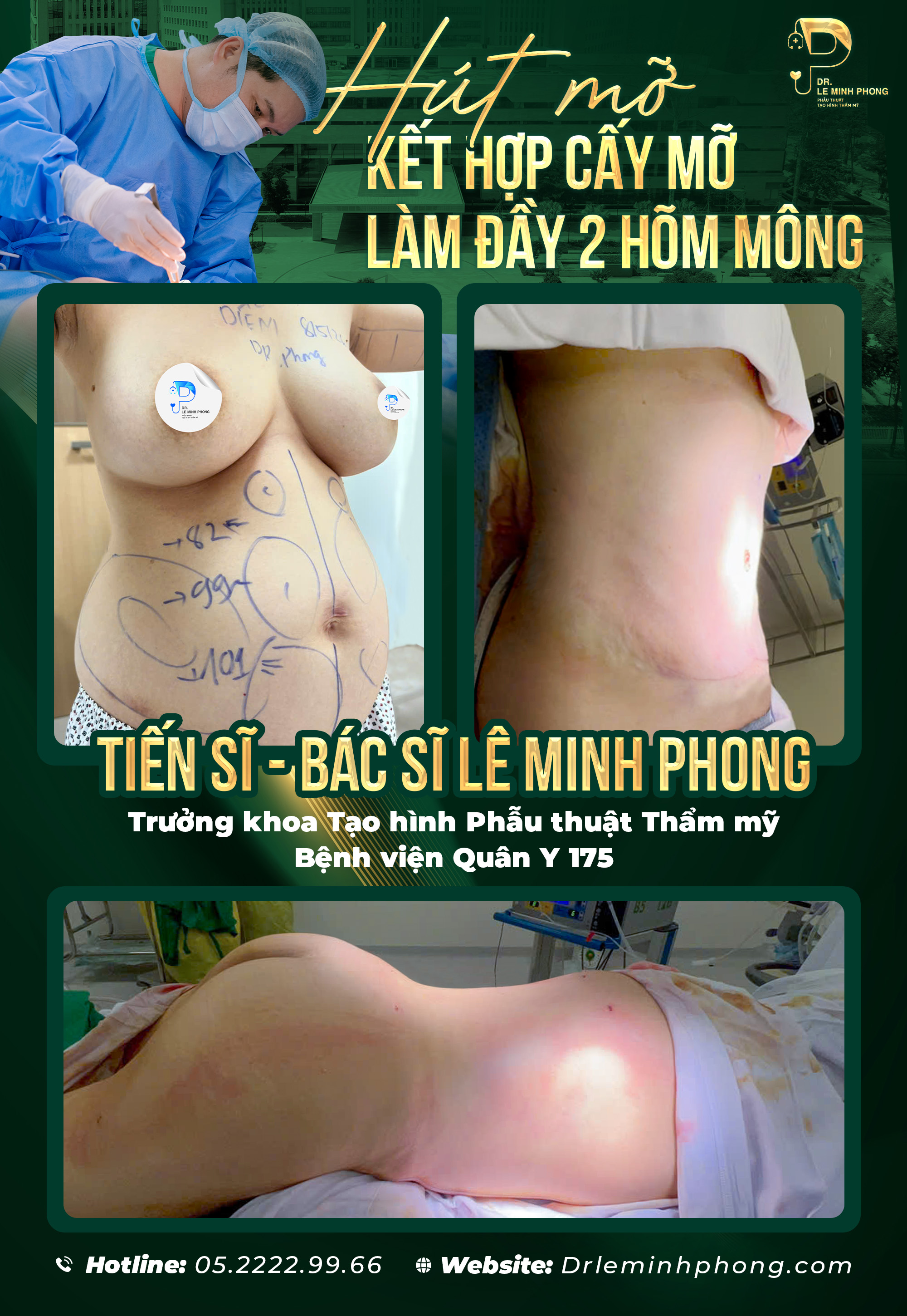 Combo Hút mỡ bụng kết hợp Cấy Mông To căng tròn đầy