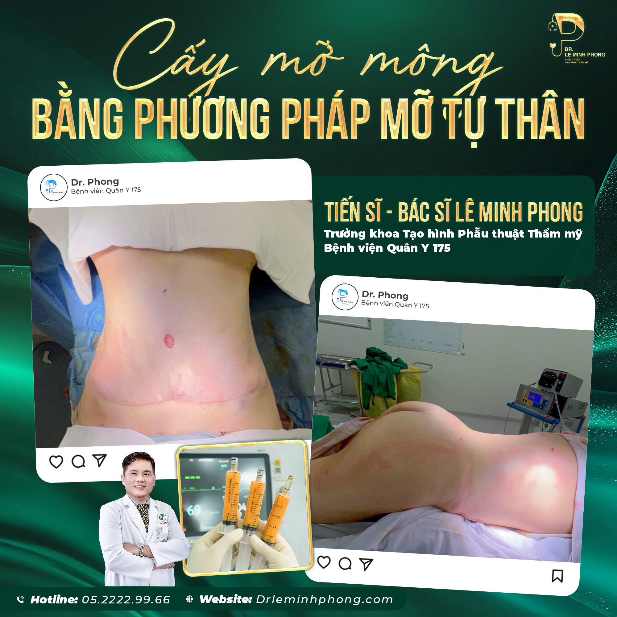 Combo Cấy mỡ mông tự thân, căng tròn kết hợp khi hút mỡ