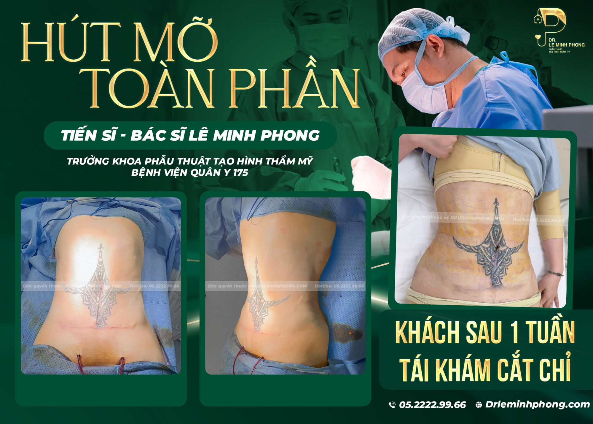 Hút Mỡ Toàn Phần – Tạo Đường Cong Cân Đối, Tự Nhiên