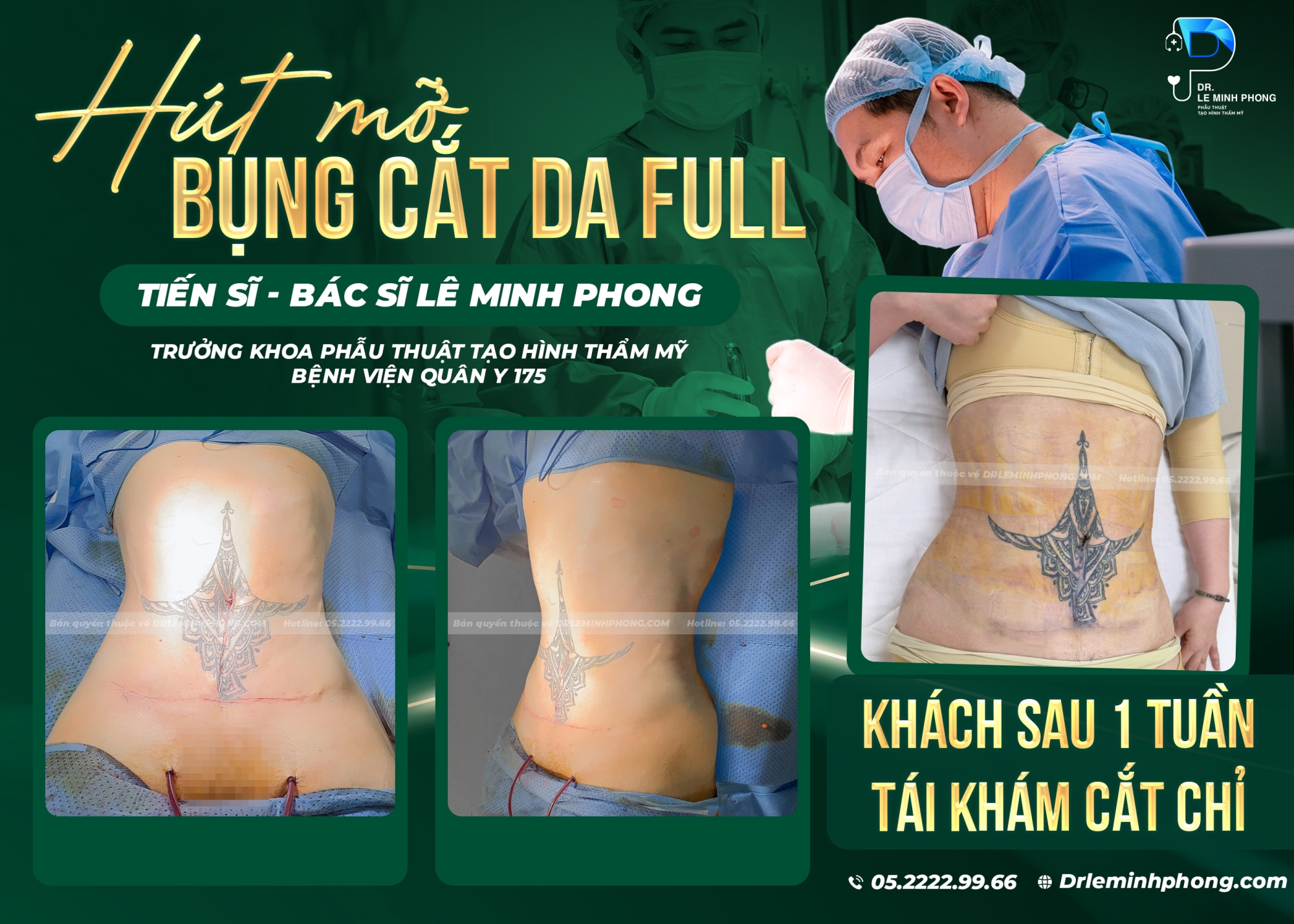Hút mỡ bụng, cắt da Full sau 1 tuần cắt chỉ