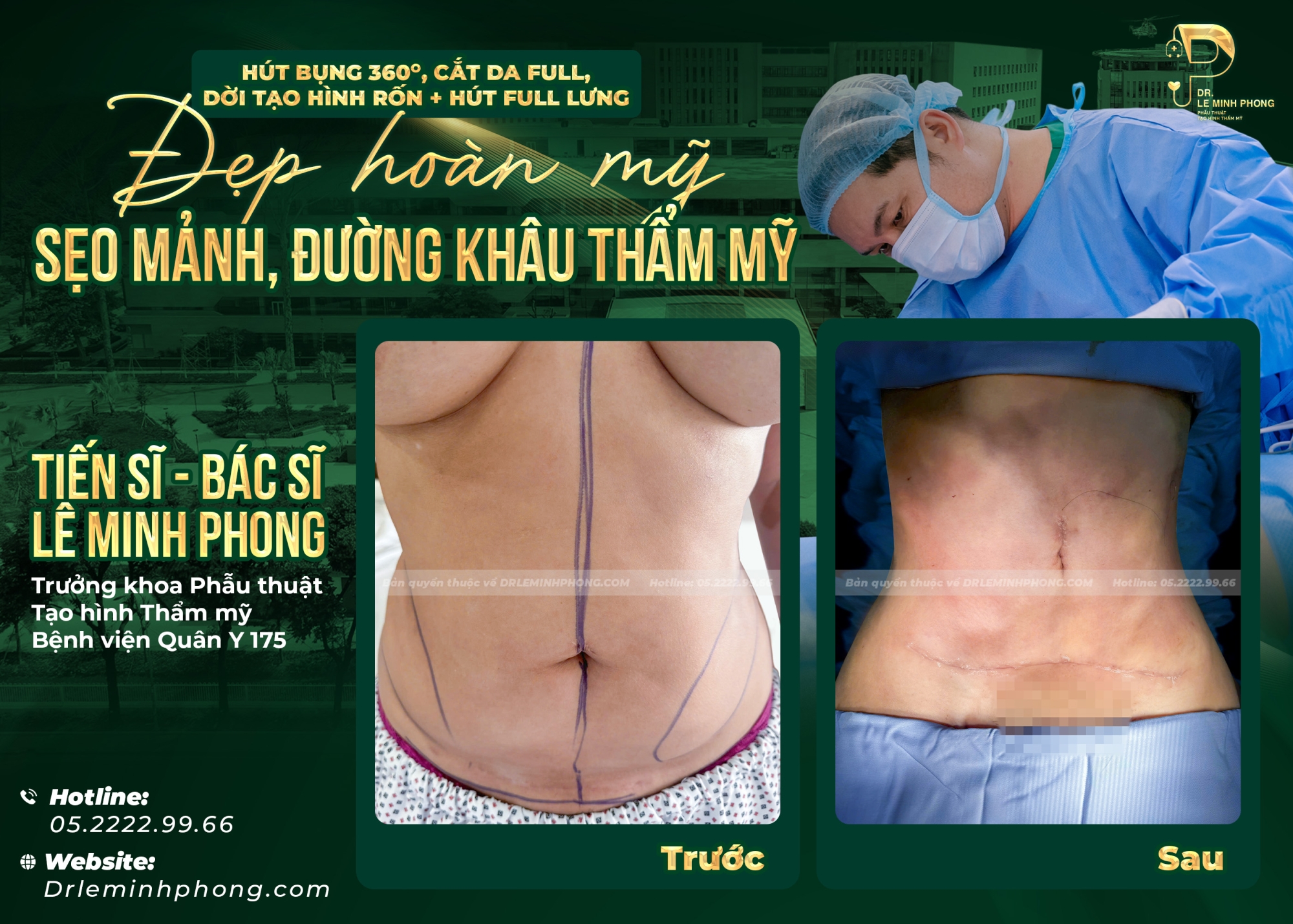 Hút mỡ bụng, lưng , eo tạo hình bụng, cắt da full,  tình trạng khách hàng khung xương to