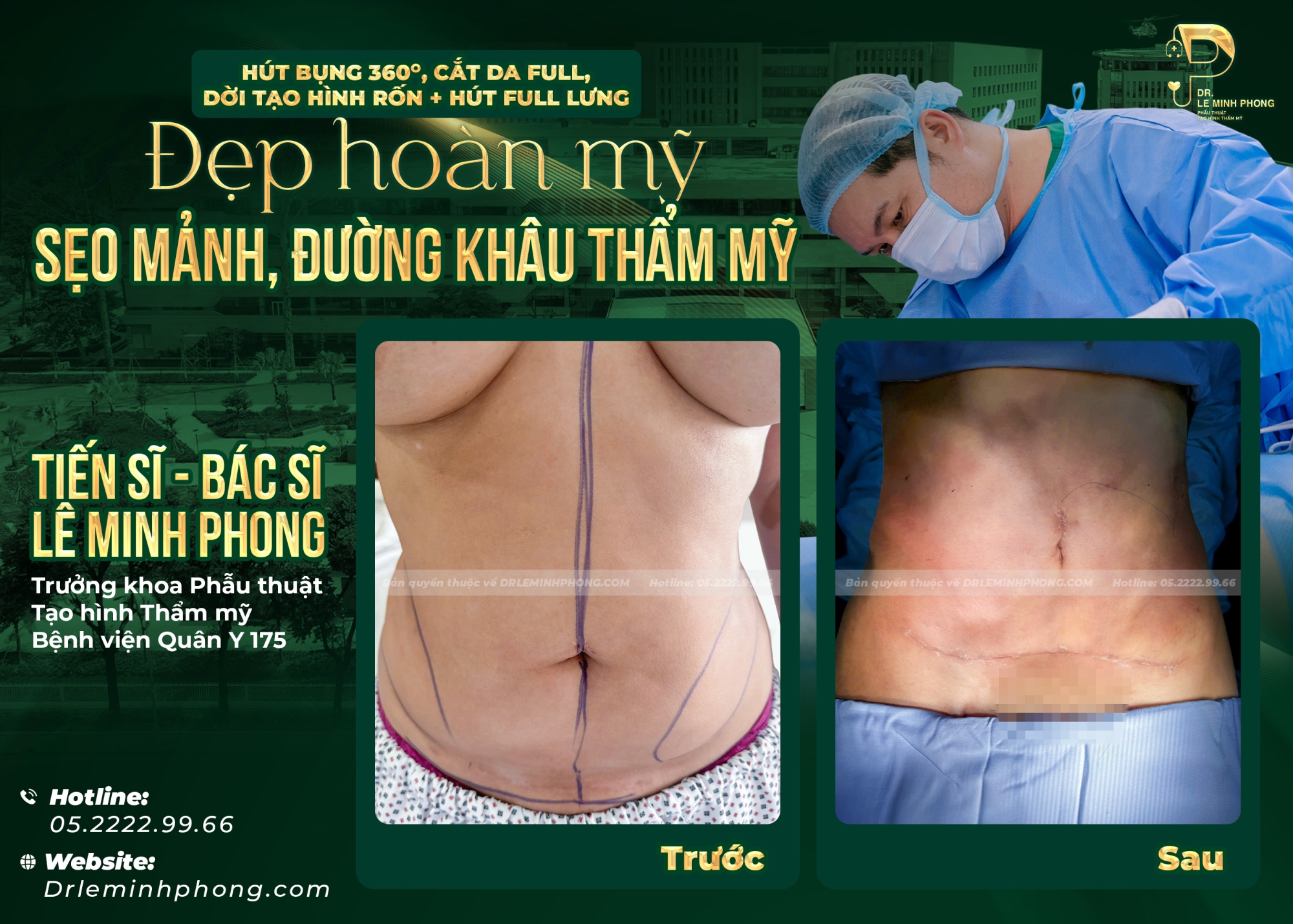 Hút Mỡ Toàn Vùng Bụng 360 Độ, Lưng Kết Hợp Dời Rốn Thẩm Mỹ