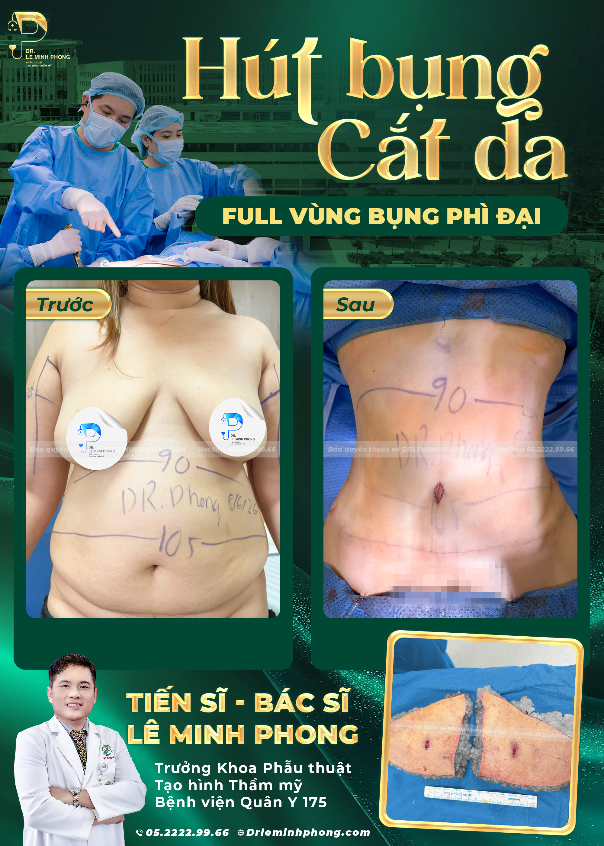 Hút mỡ bụng, cắt da full, dời rốn, bụng phì đại, da trùng nhiều
