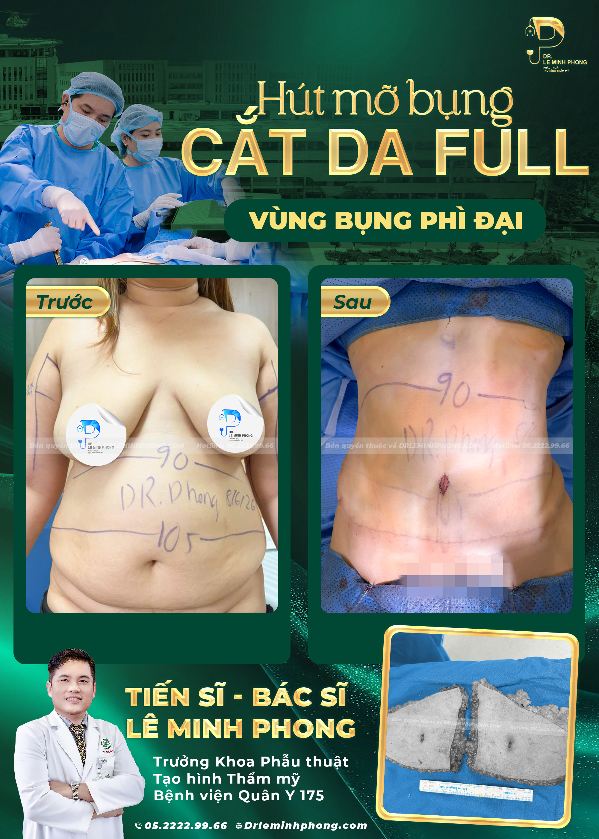 Hút Mỡ Bụng Kết Hợp Cắt Da Toàn Phần Cho Vùng Bụng Phì Đại
