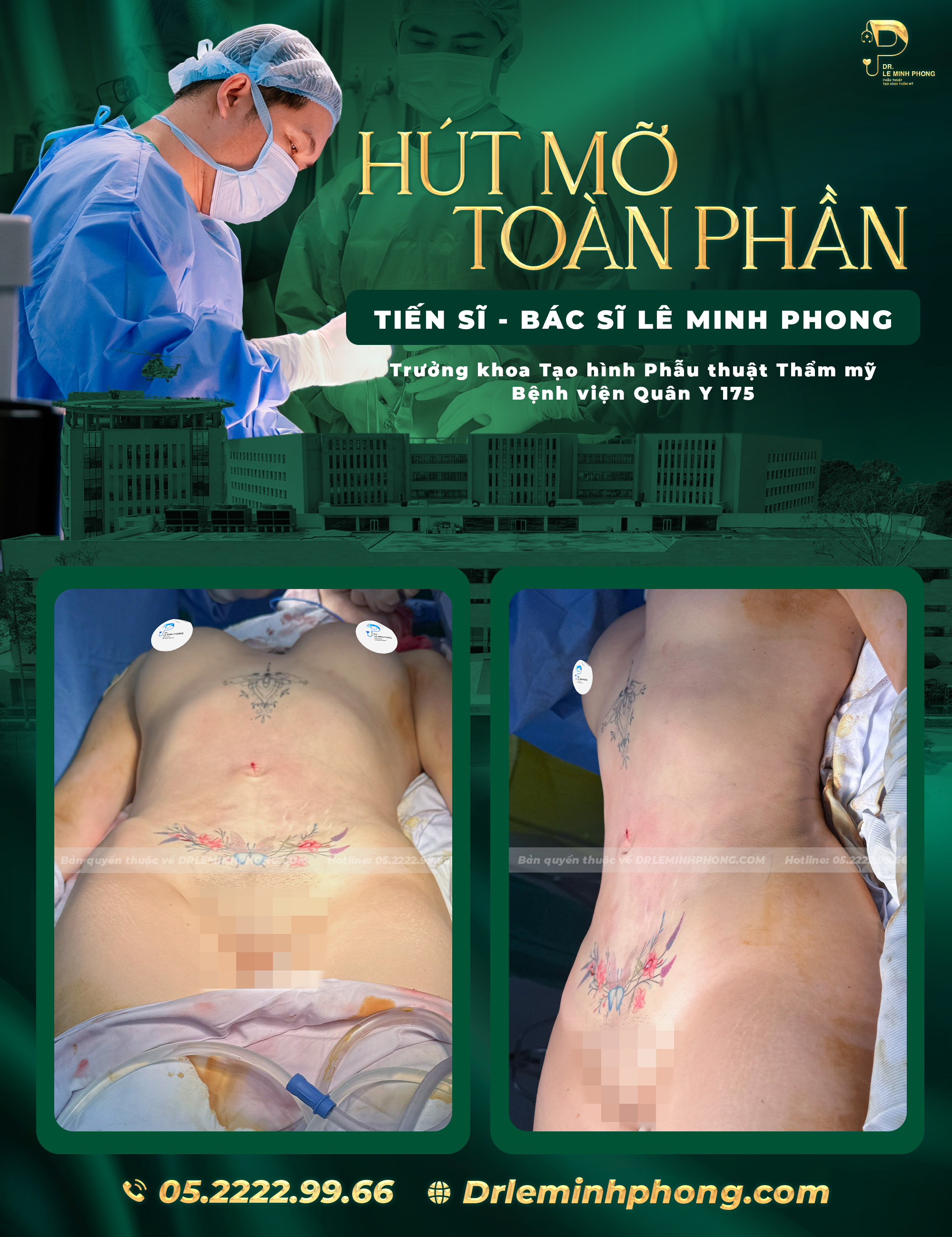 Hút Mỡ Toàn Phần An Toàn Tại Bệnh Viện Quân Y 175