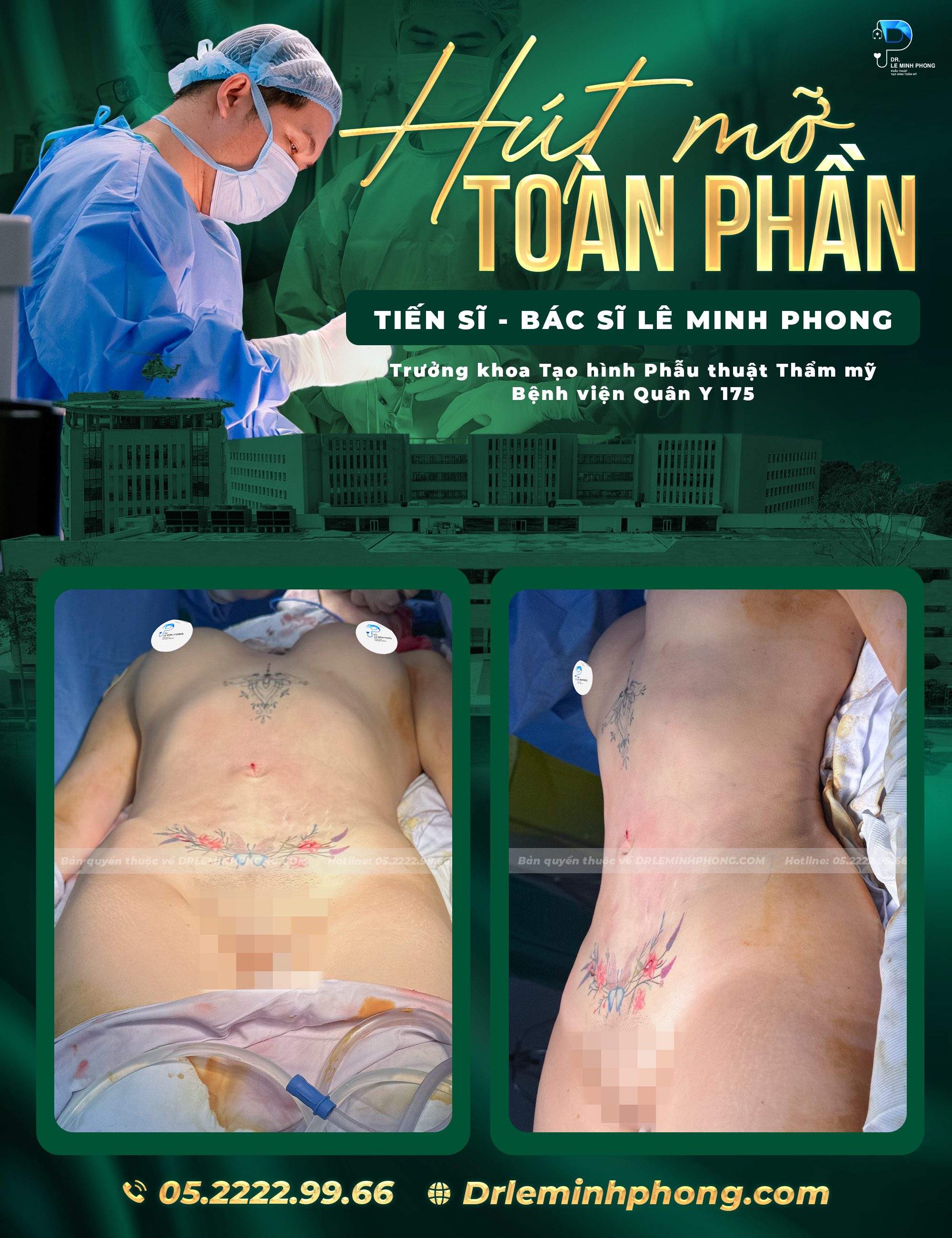 Hút mỡ bụng lưng eo 360 siết căng tạo hình bụng