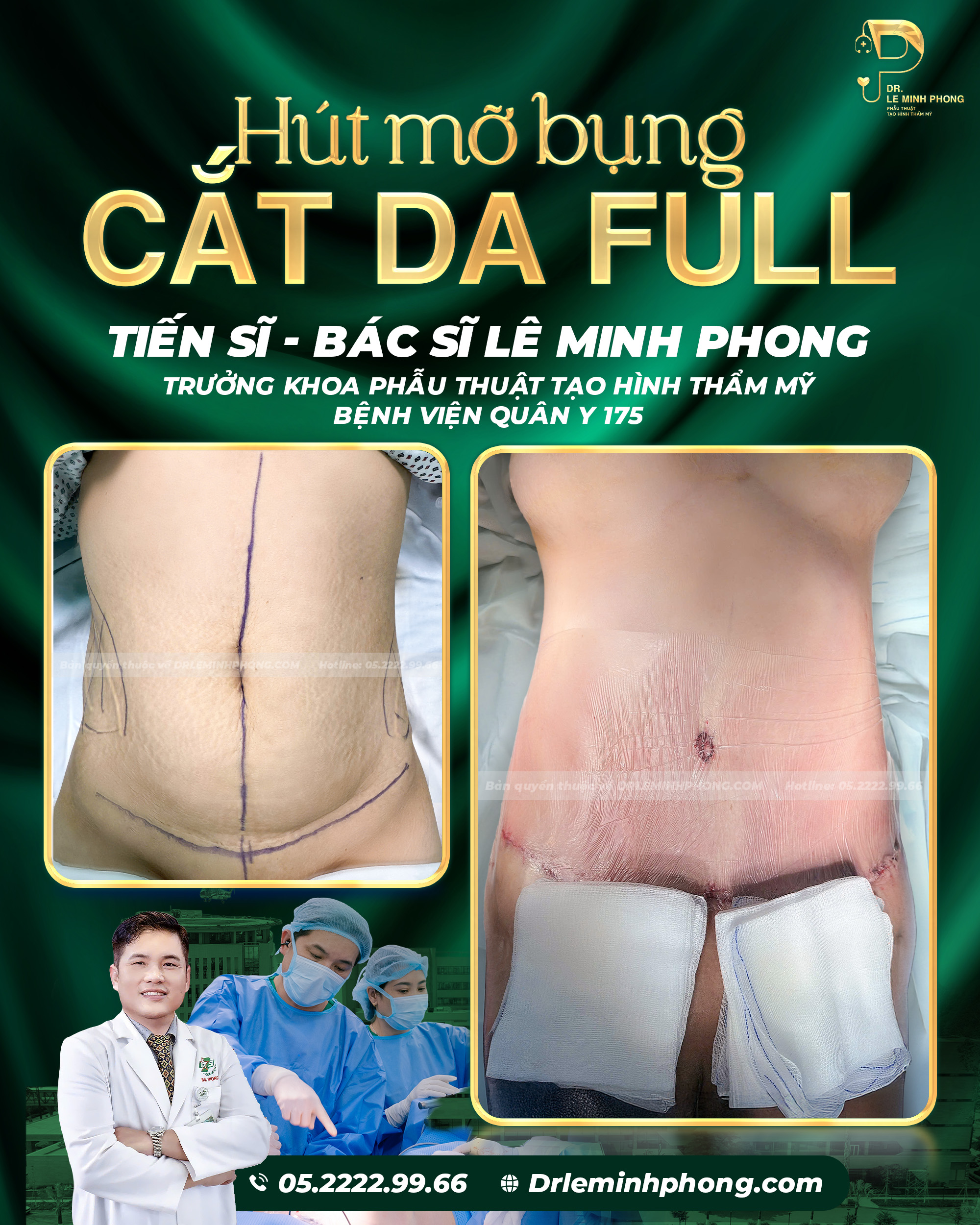Hút Mỡ Bụng, Cắt Da Thừa Toàn Phần – Kiến Tạo Thành Bụng Săn Chắc
