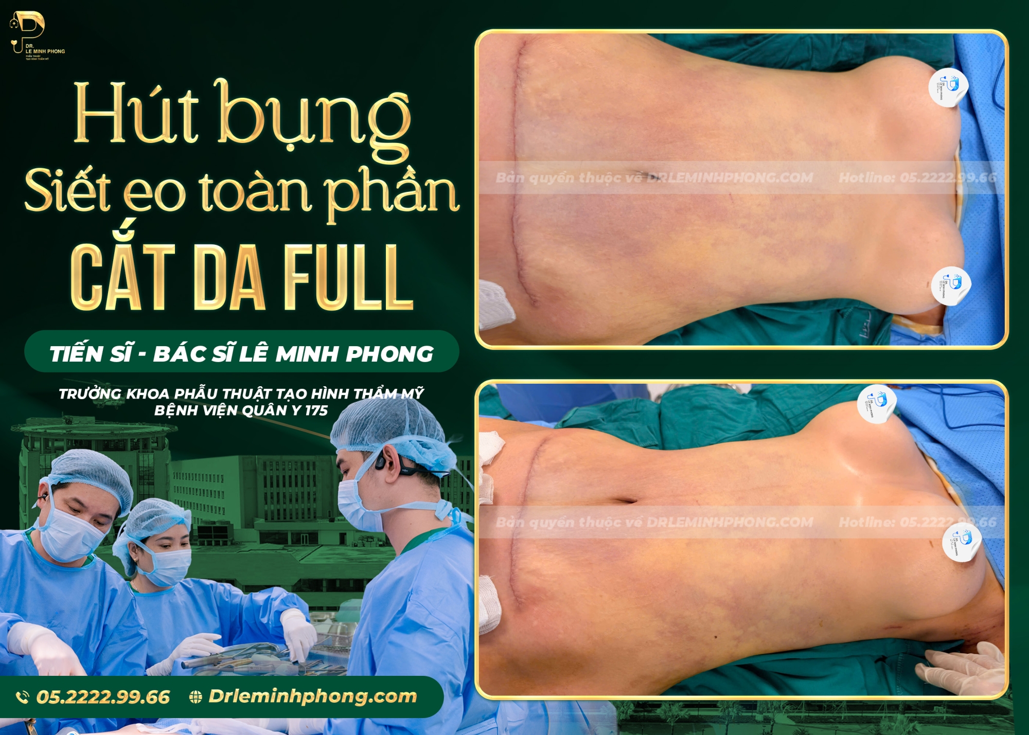 Hút Mỡ Toàn Phần Kết Hợp Siết Eo Và Cắt Da Bụng Full