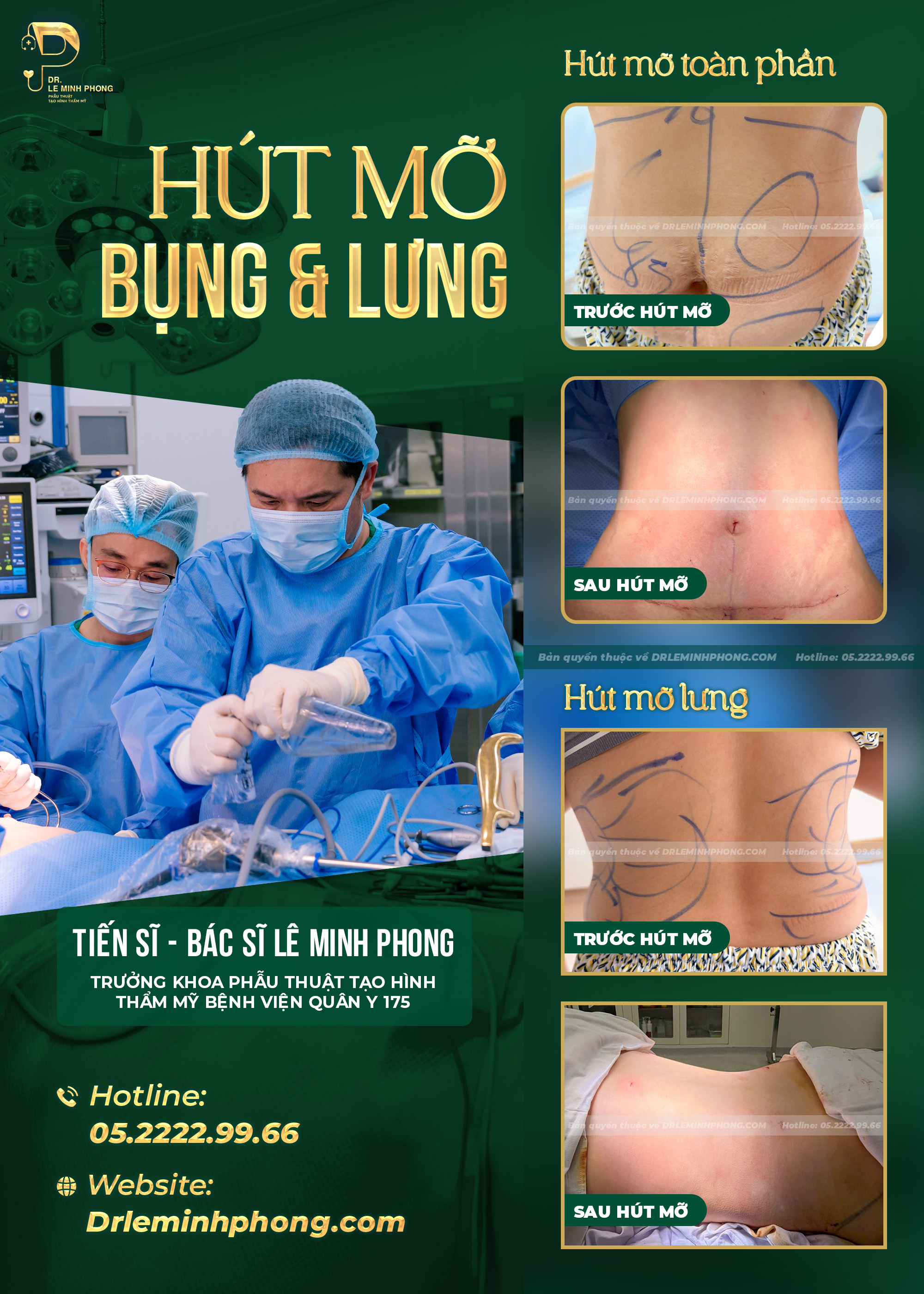 Hút mỡ bụng & lưng – không chỉ cải thiện mỡ thừa mà còn hướng đến tạo hình vòng eo cân đối, đường nét rõ ràng hơn