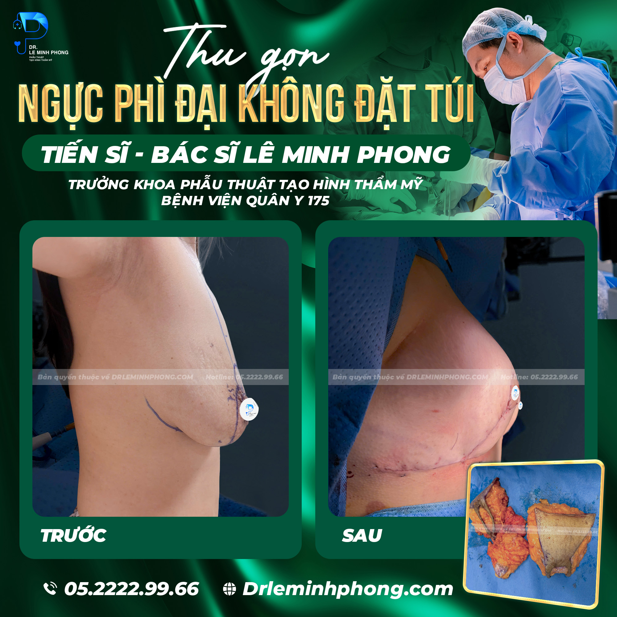 Thu gọn ngực phì đại, kết hợp treo sa trễ đường mỏ neo (chữ T), sẹo đường chữ T