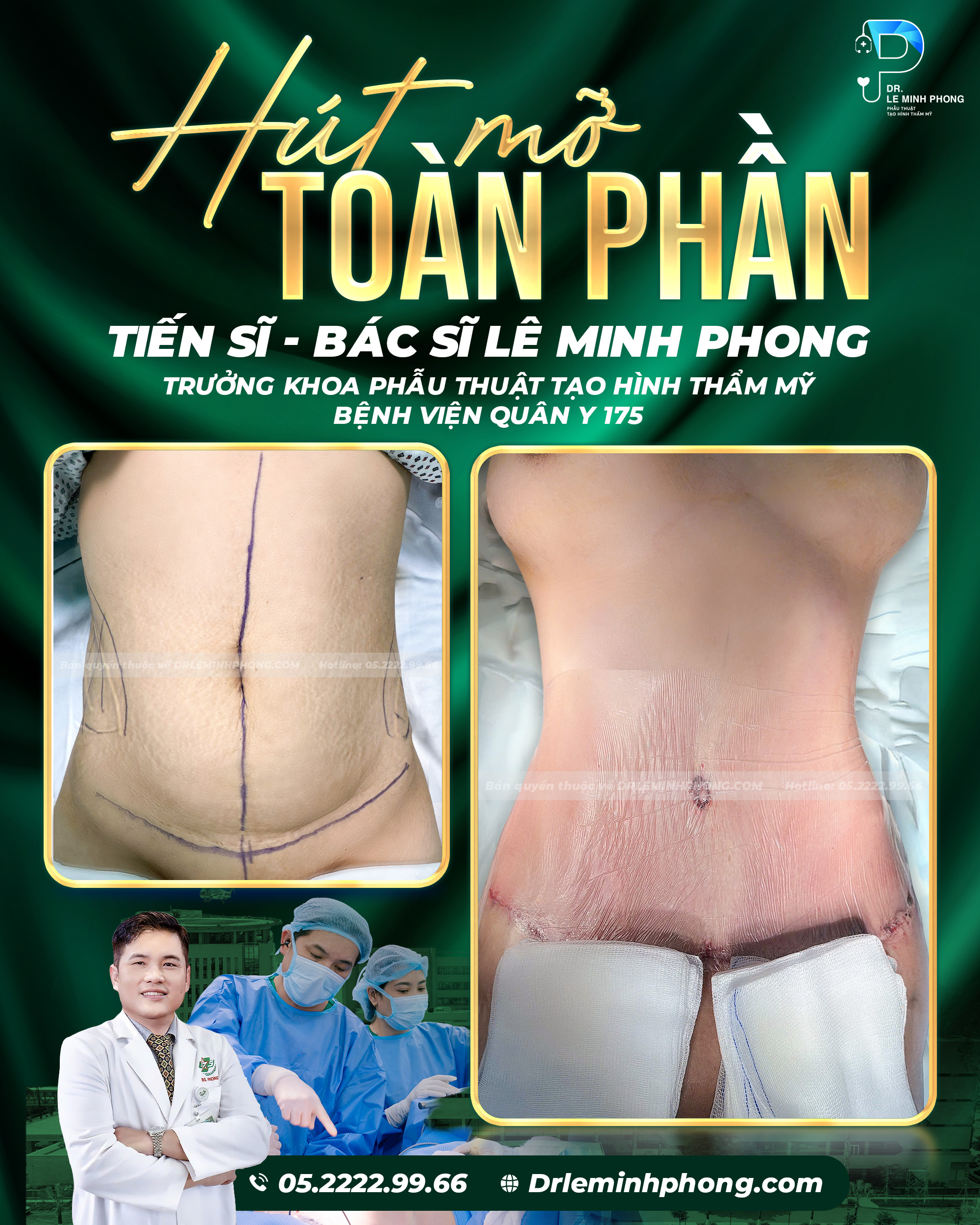 Hút mỡ toàn phần – Kiến tạo đường cong hài hòa, nâng tầm sự tự tin