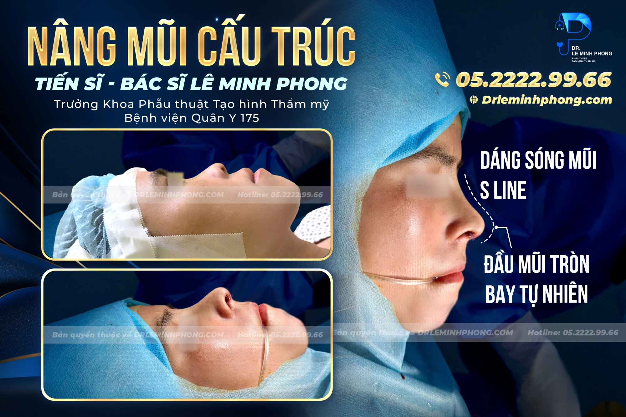Nâng mũi cấu trúc S-Line –Dáng mũi thanh tú, đầu mũi tròn tự nhiên