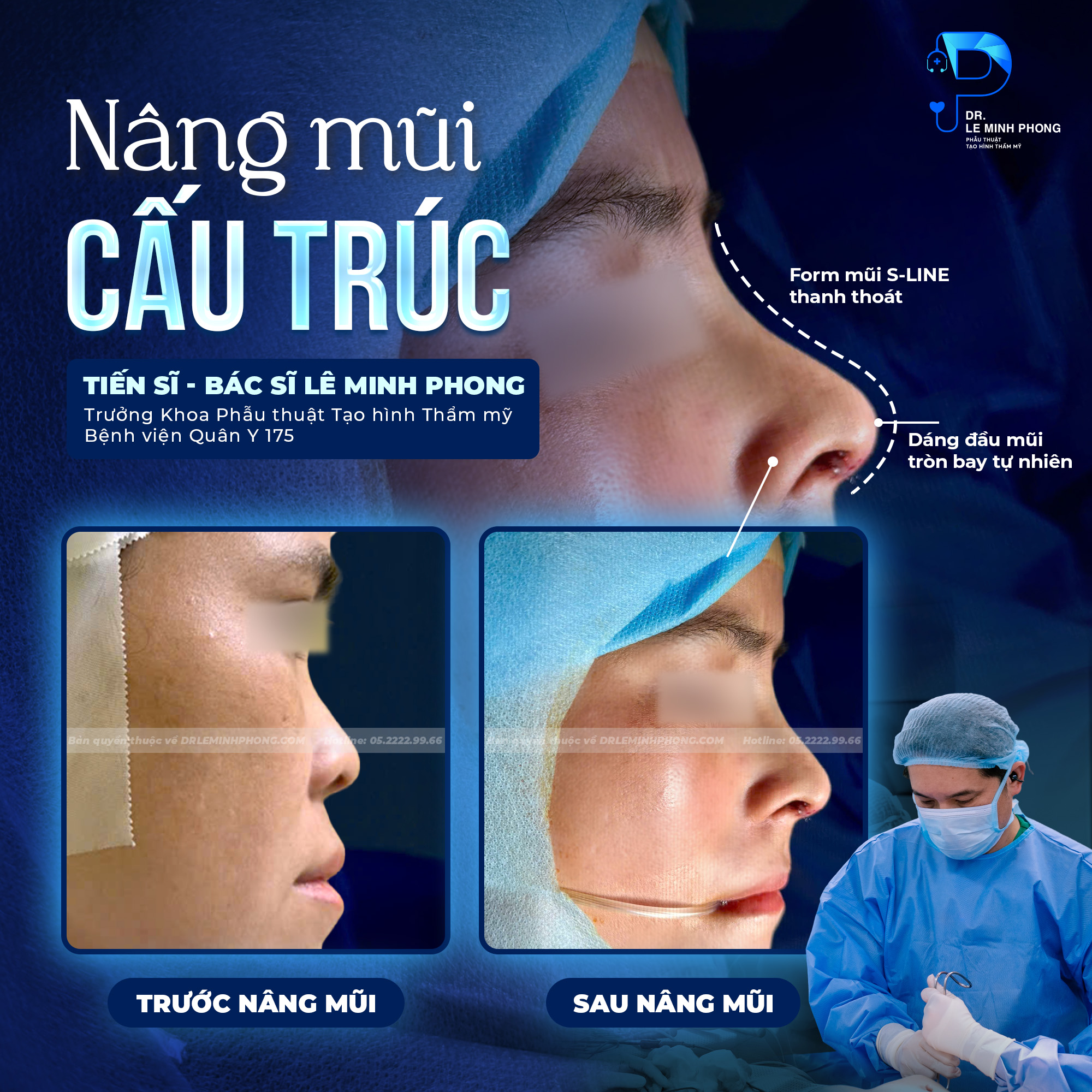 Nâng mũi cấu trúc – Kiến tạo dáng mũi hài hòa, cân đối với gương mặt cùng TS.BS Lê Minh Phong tại BV Quân Y 175