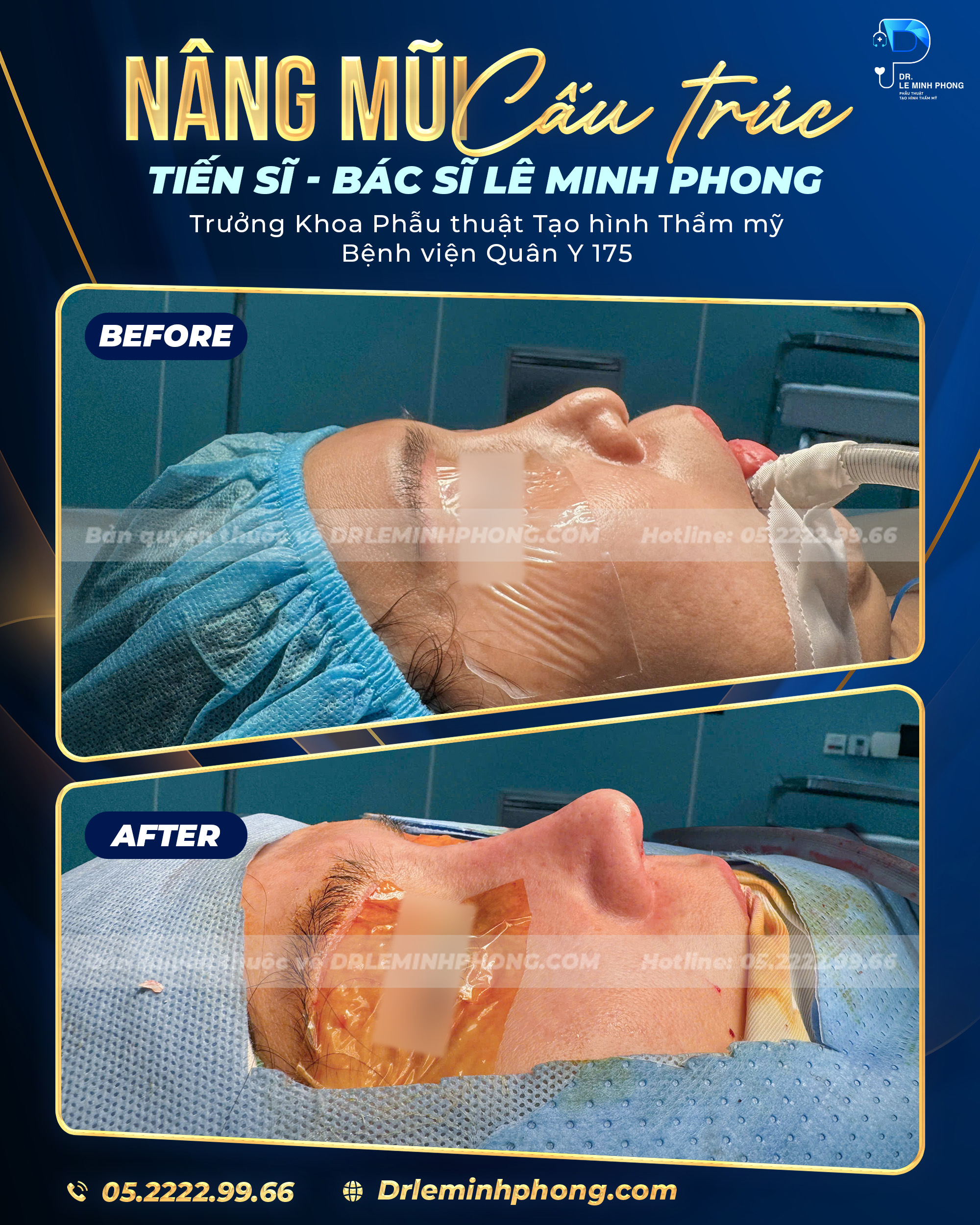 Nâng mũi cấu trúc – Dáng mũi tự nhiên, hài hòa và cân đối