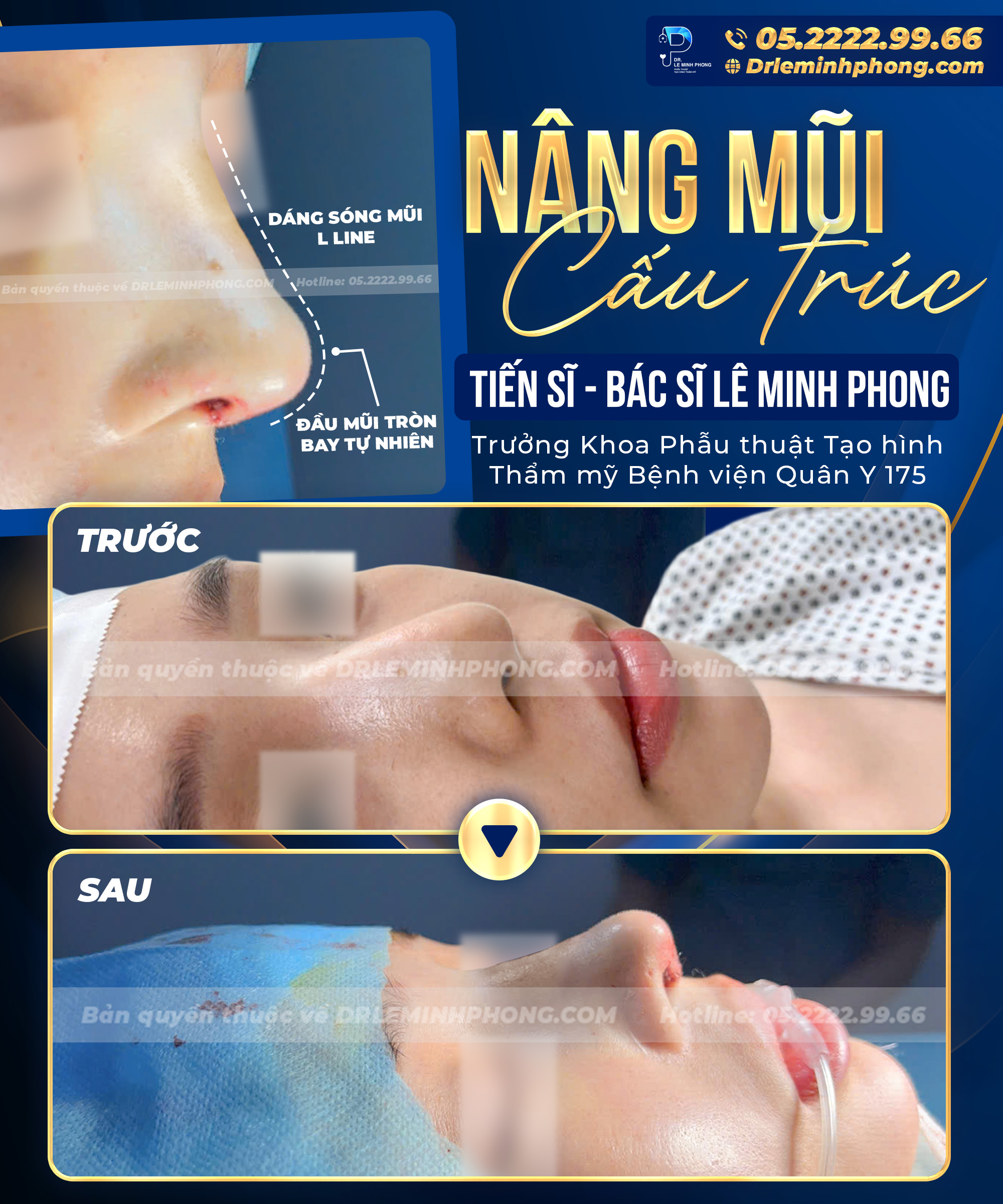 Nâng mũi cấu trúc L-Line - Dáng mũi cao thanh thoát, tự nhiên