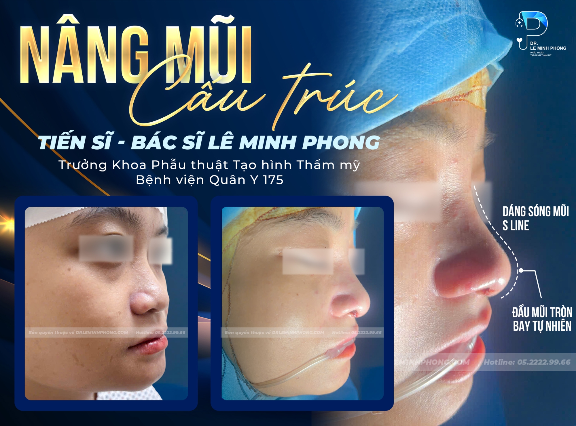 Nâng mũi cấu trúc – vẻ đẹp tự nhiên từ mọi góc nhìn
