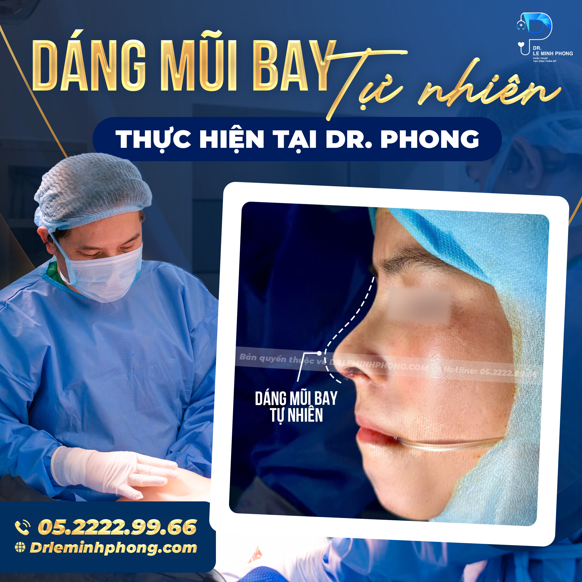Dáng mũi bay tự nhiên thực hiện tại Dr. Phong